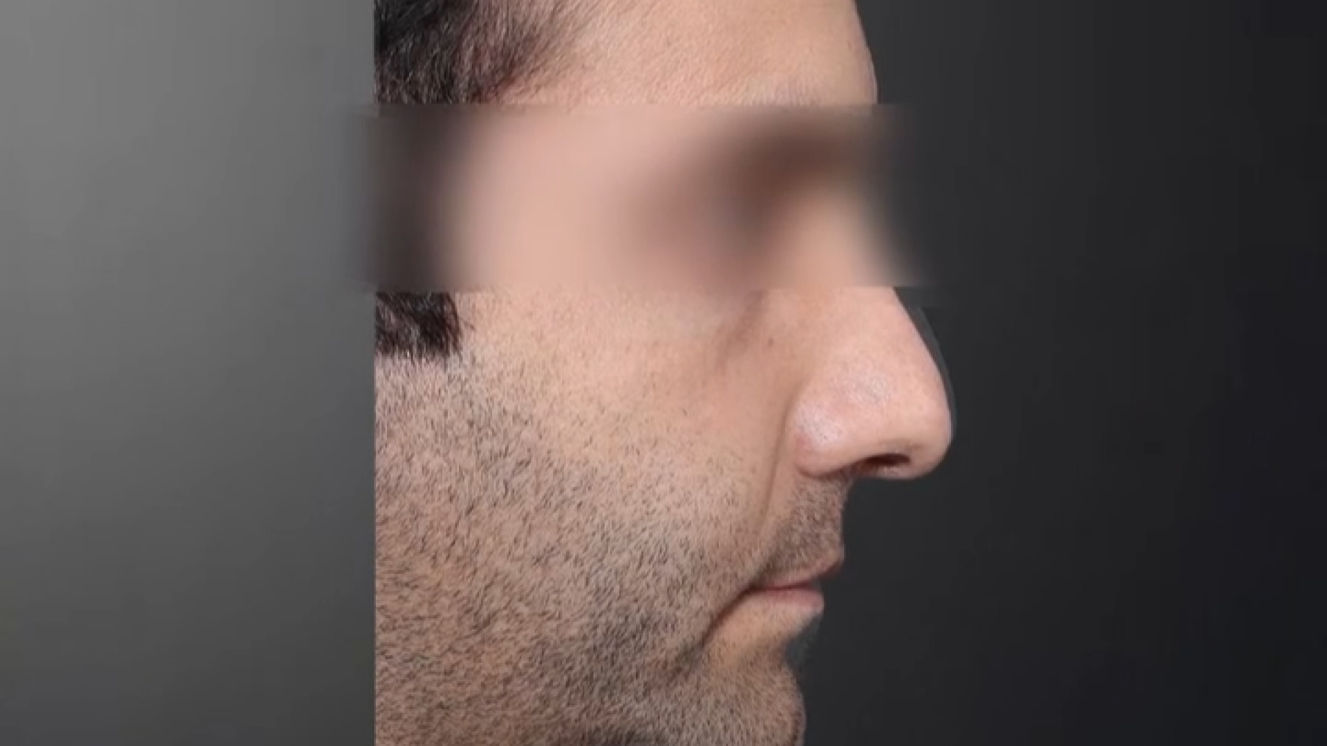 ارتودنسی و جراحی فک(ارتوسرجری)به منظور بهبود نشاندن دندانهای دو فک… بایوفیزیک پزشکی