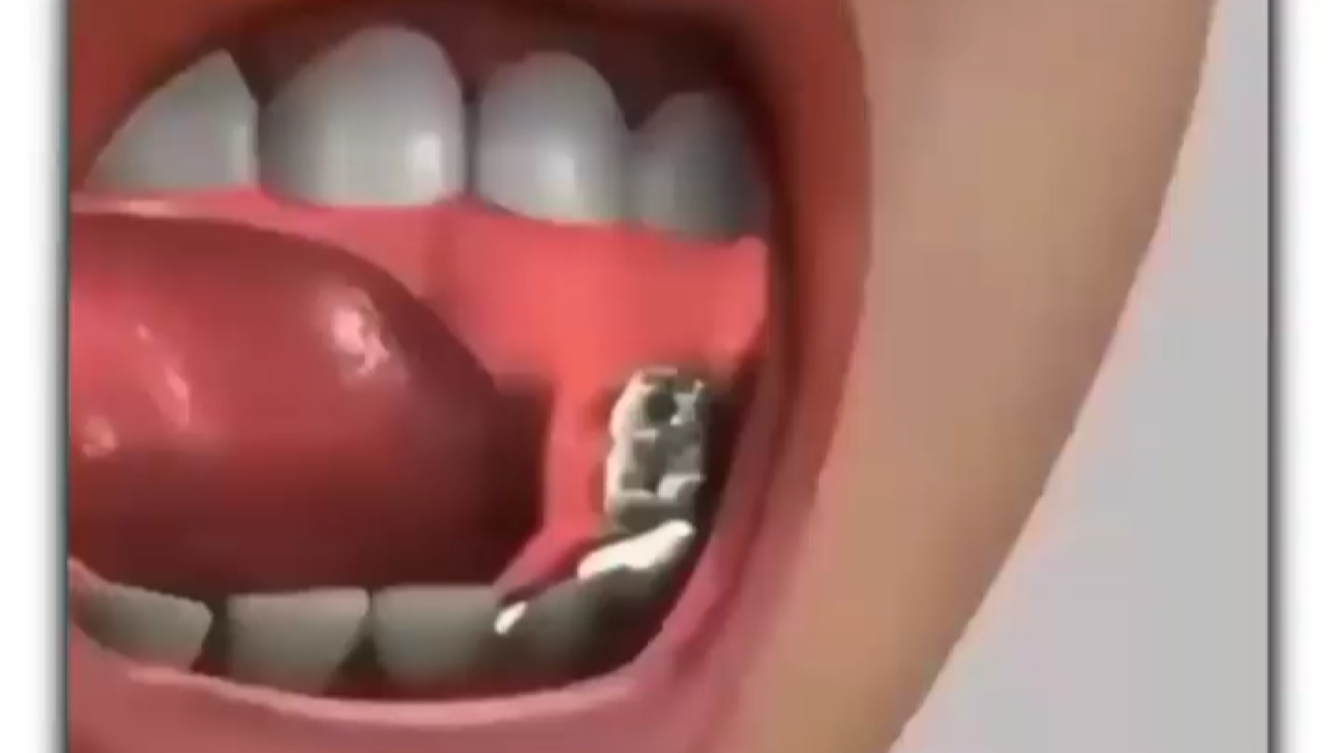 تزریق بی حسی فک پایین لیفت صورت
