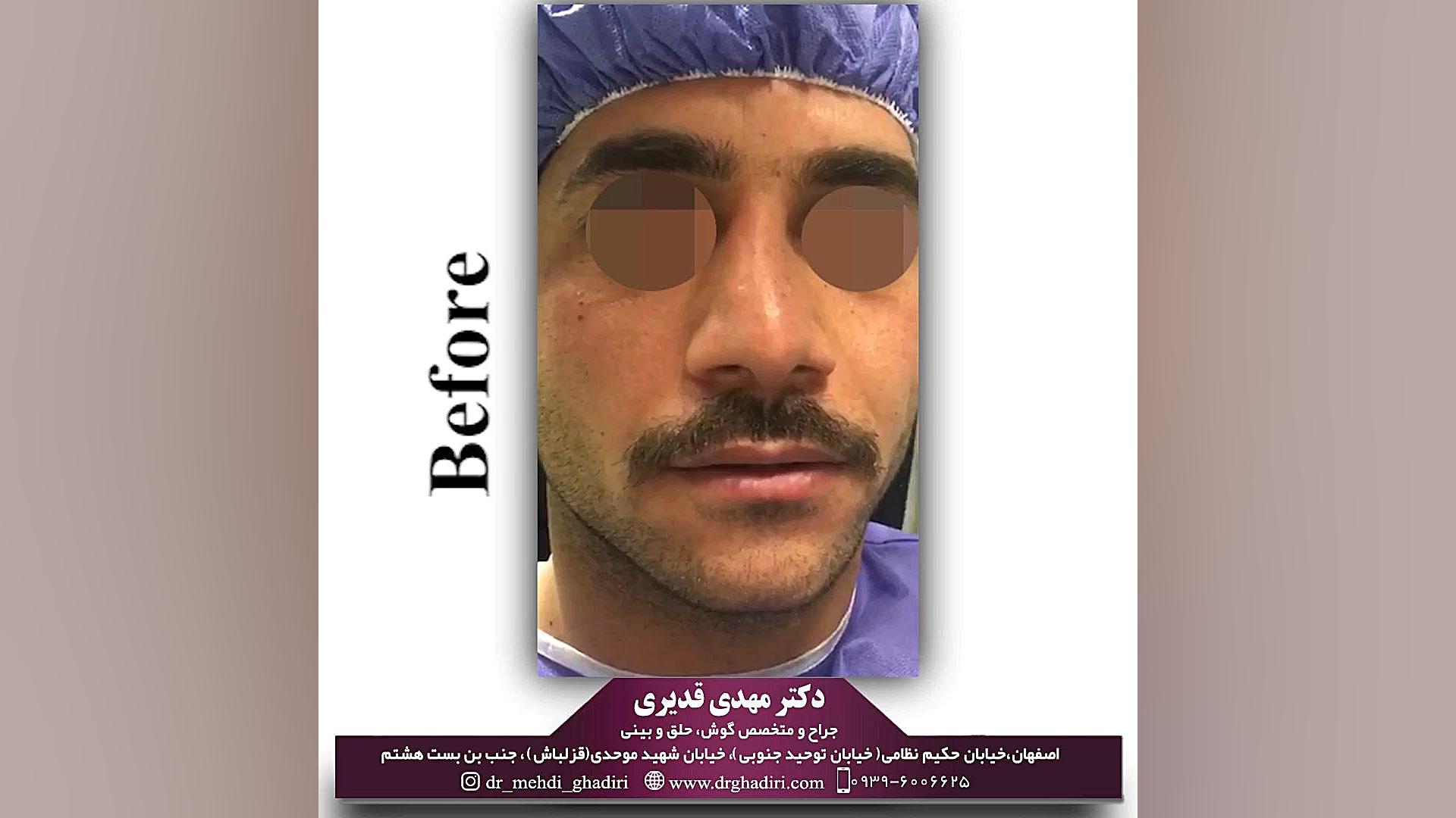 جراحی بینی دکتر مهدی قدیری