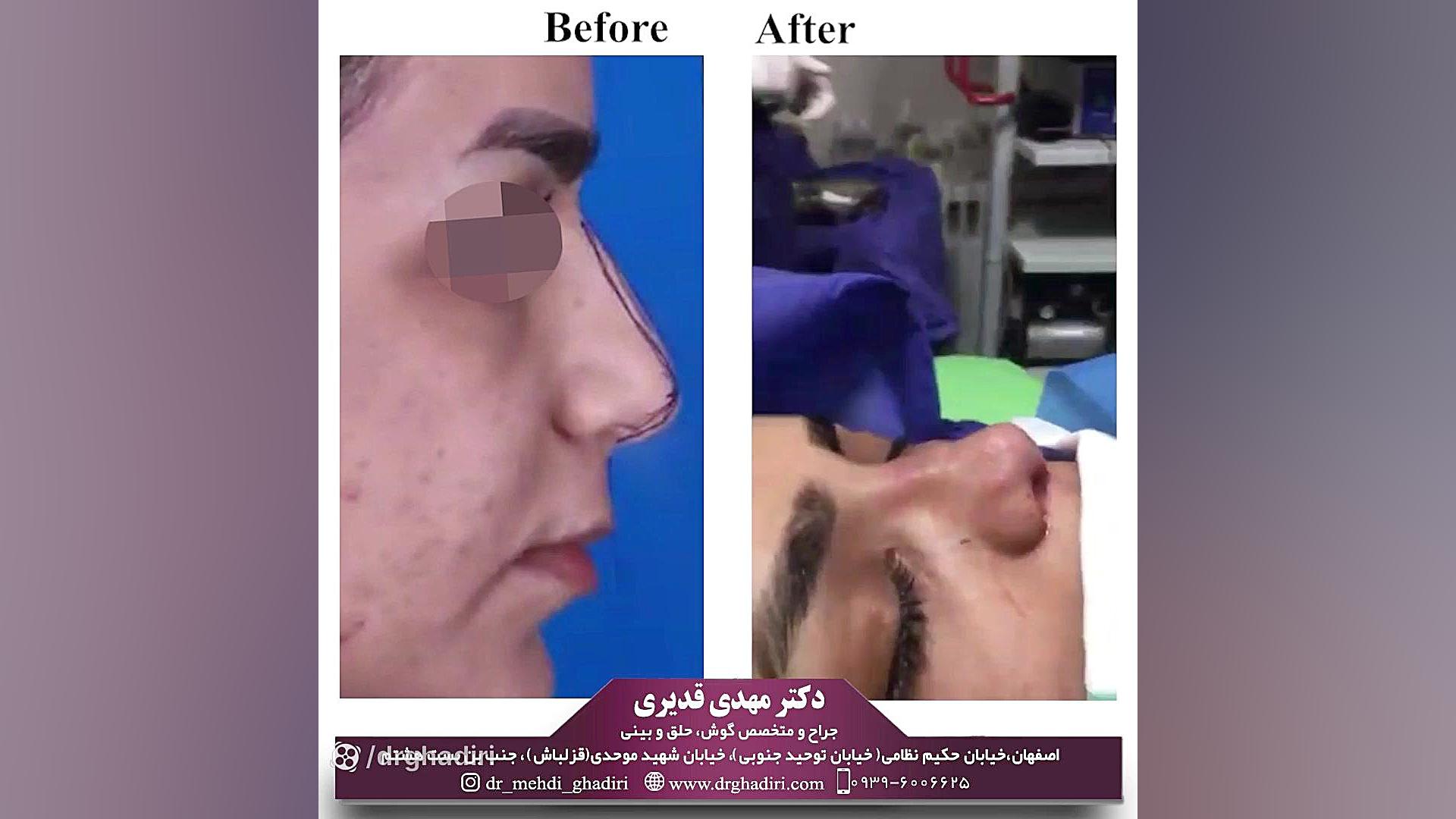 جراحی بینی دکتر مهدی قدیری