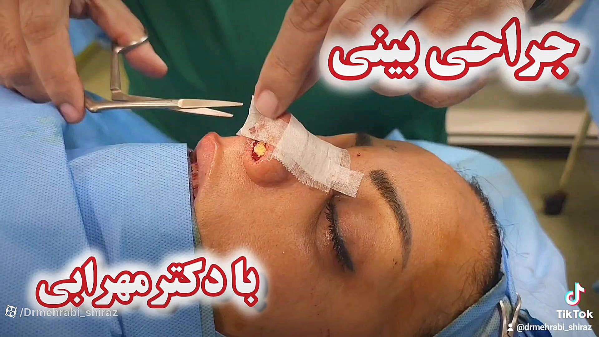بینی_گوشتی #تیپ_پلاستی_بینی بینی_کج بینی طبیعی بینی عروسکی شیراز دکترمهرابی دکتر محمد مهدی مهرابی جراح پلاستیک و زیبایی