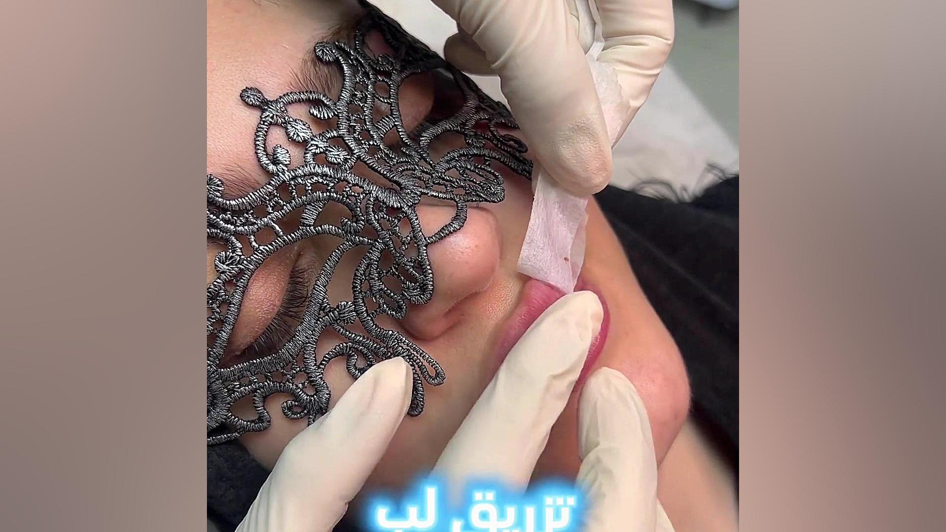 تزریق لب روسی ،تزریق لب روسی در رشت کلینیک زیبایی رشت دکتر مهدیه حسین زاده