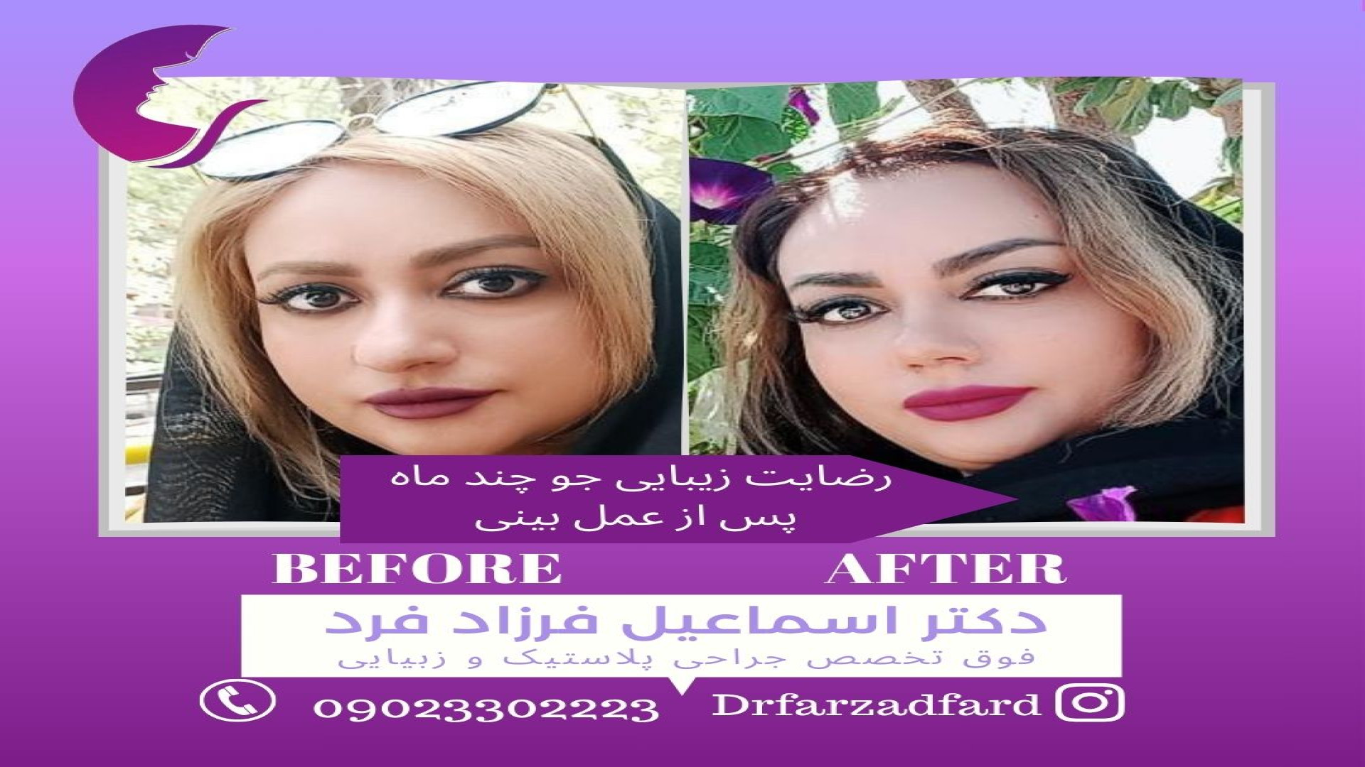رضایت زیبایی جو از جراحی رینوپلاستی (بینی) دکتر اسماعیل فرزاد فرد - فوق تخصص پلاستیک