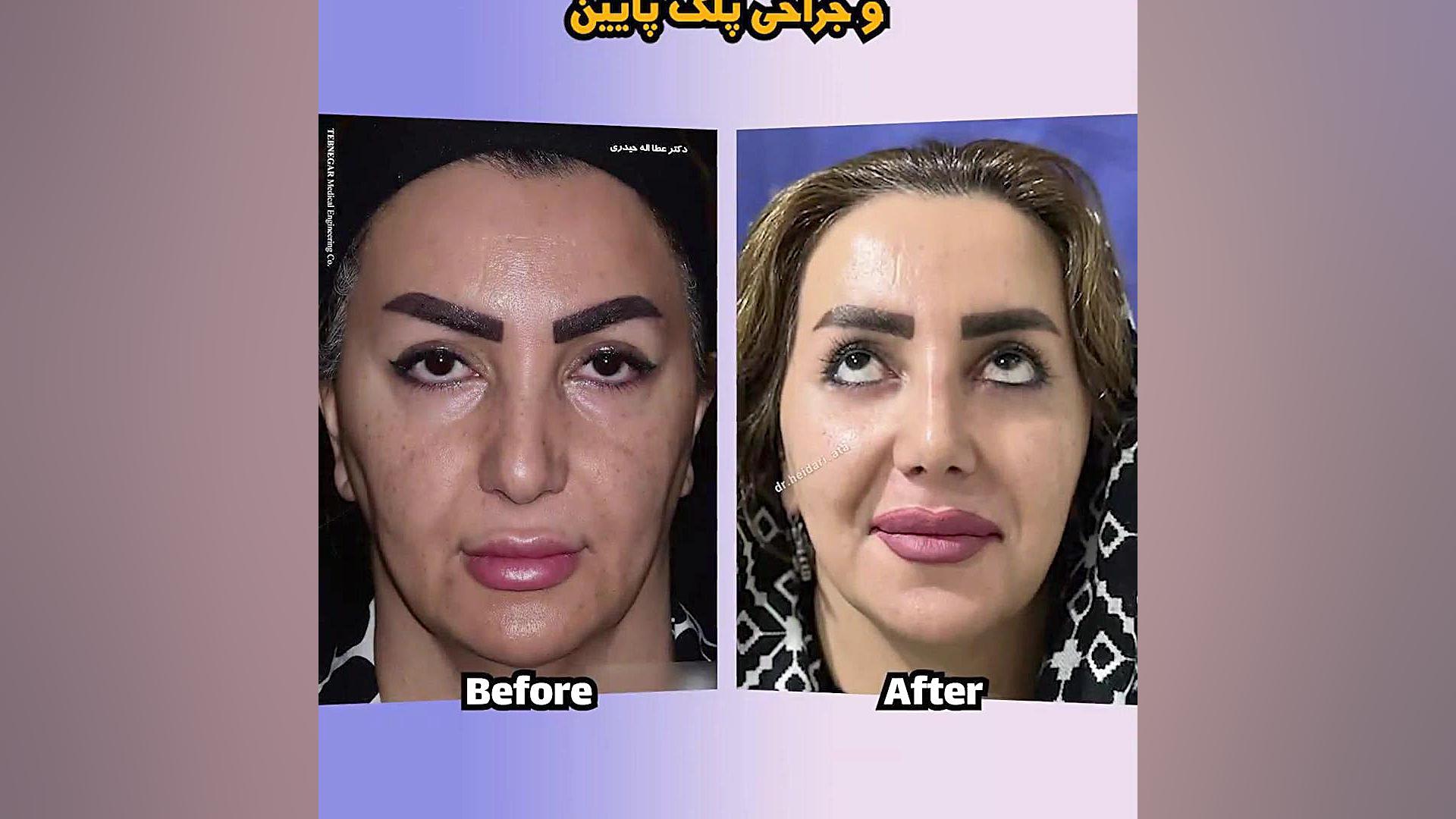 نمونه جراحی بینی توسط دکتر عطالله حیدری دستگاه فلوئورسنس تایم-لپس