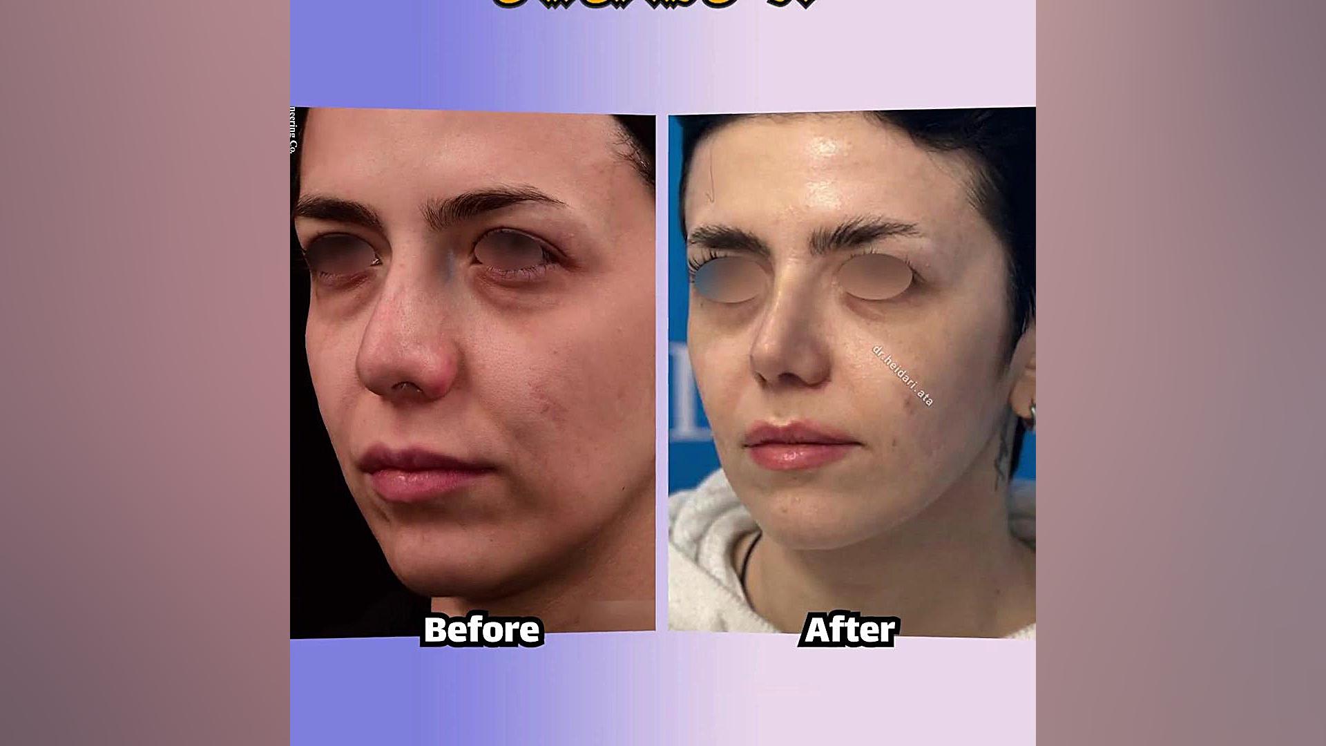 نمونه جراحی بینی استخوانی 2 توسط دکتر عطالله حیدری لیفت صورت