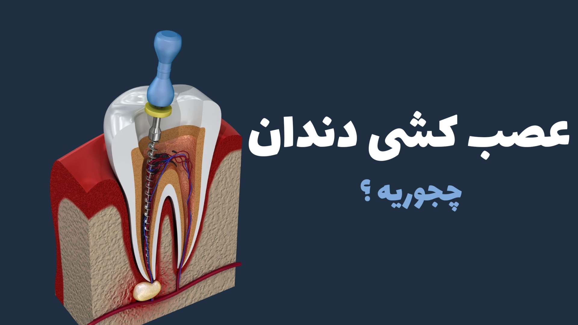 عصب کشی دندان چگونه است ؟ میکرونیدلینگ