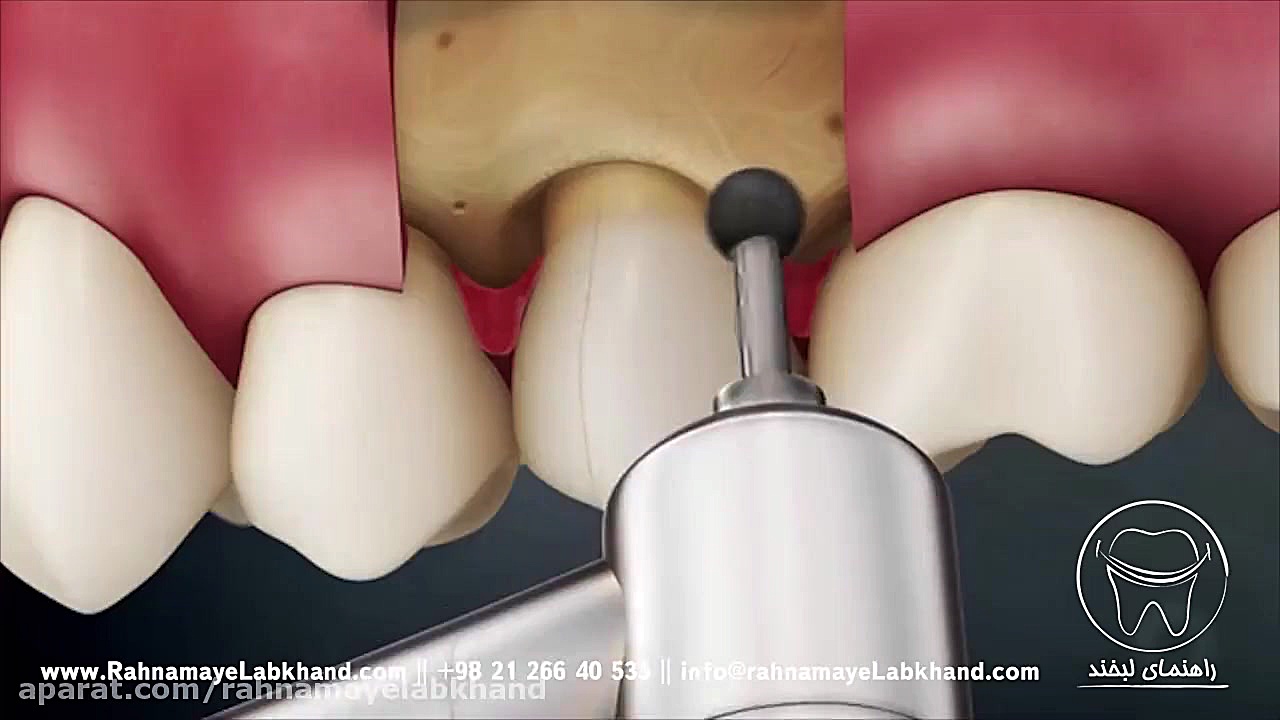 روکش دندان دستگاه DNA-Chip