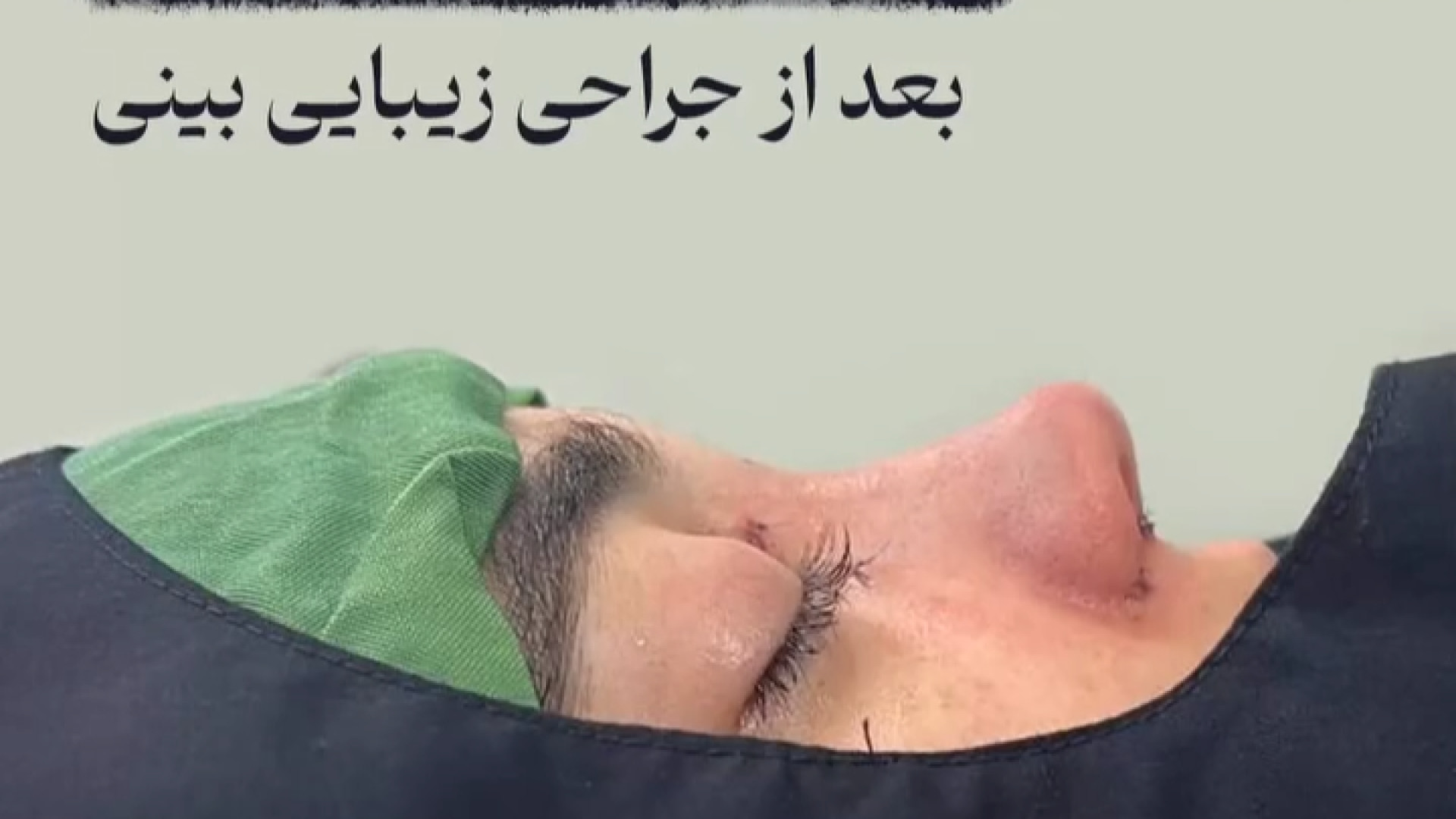 بلافاصله بعد از جراحی زیبایی بینی | دکتر علی واجاری دکتر علی حسینی واجاری - جراح بینی رشت