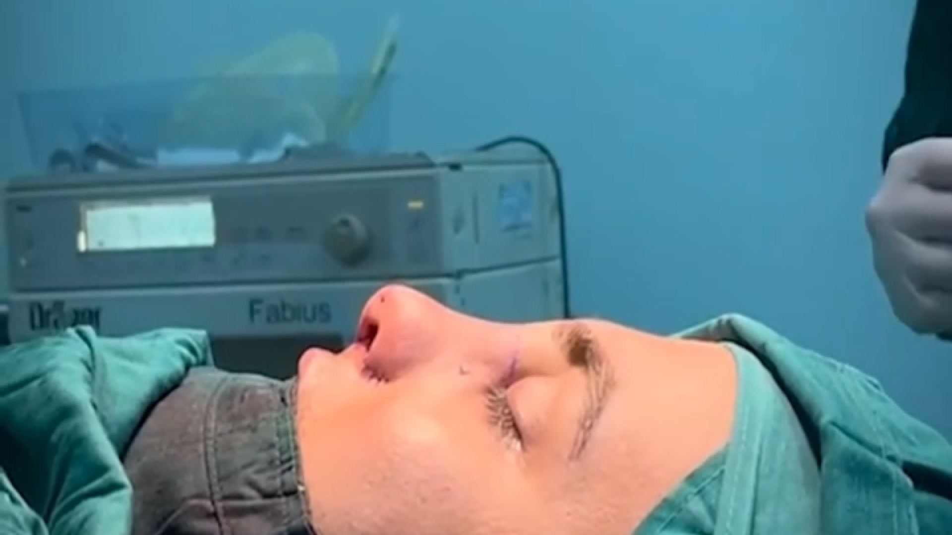 بینی قوزدار با انحراف شدید و غیرقرینگی سوراخ ها | دکتر علی واجاری دکتر علی حسینی واجاری - جراح بینی رشت