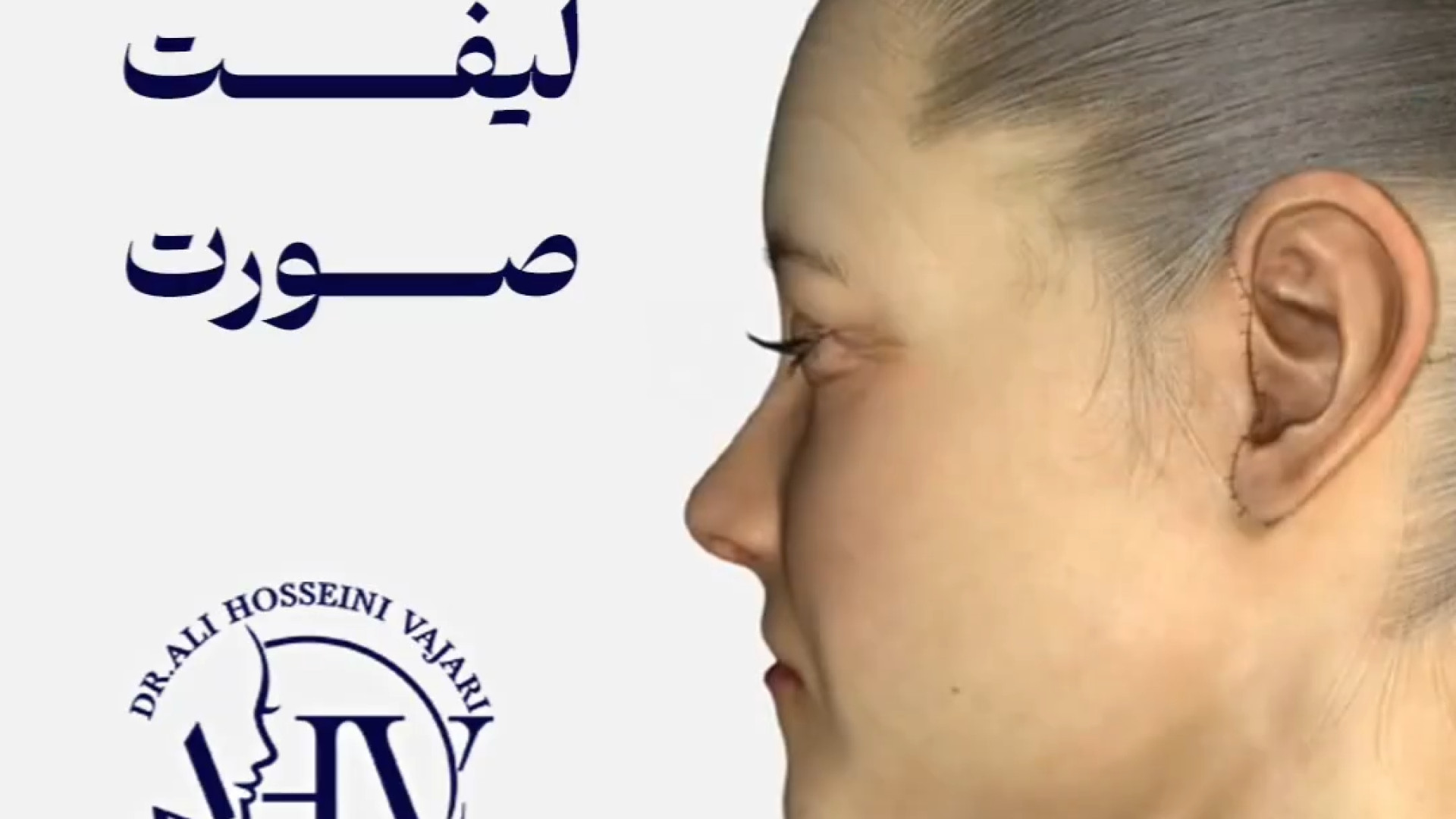 جراحی لیفت صورت | دکتر علی واجاری دکتر علی حسینی واجاری - جراح بینی رشت