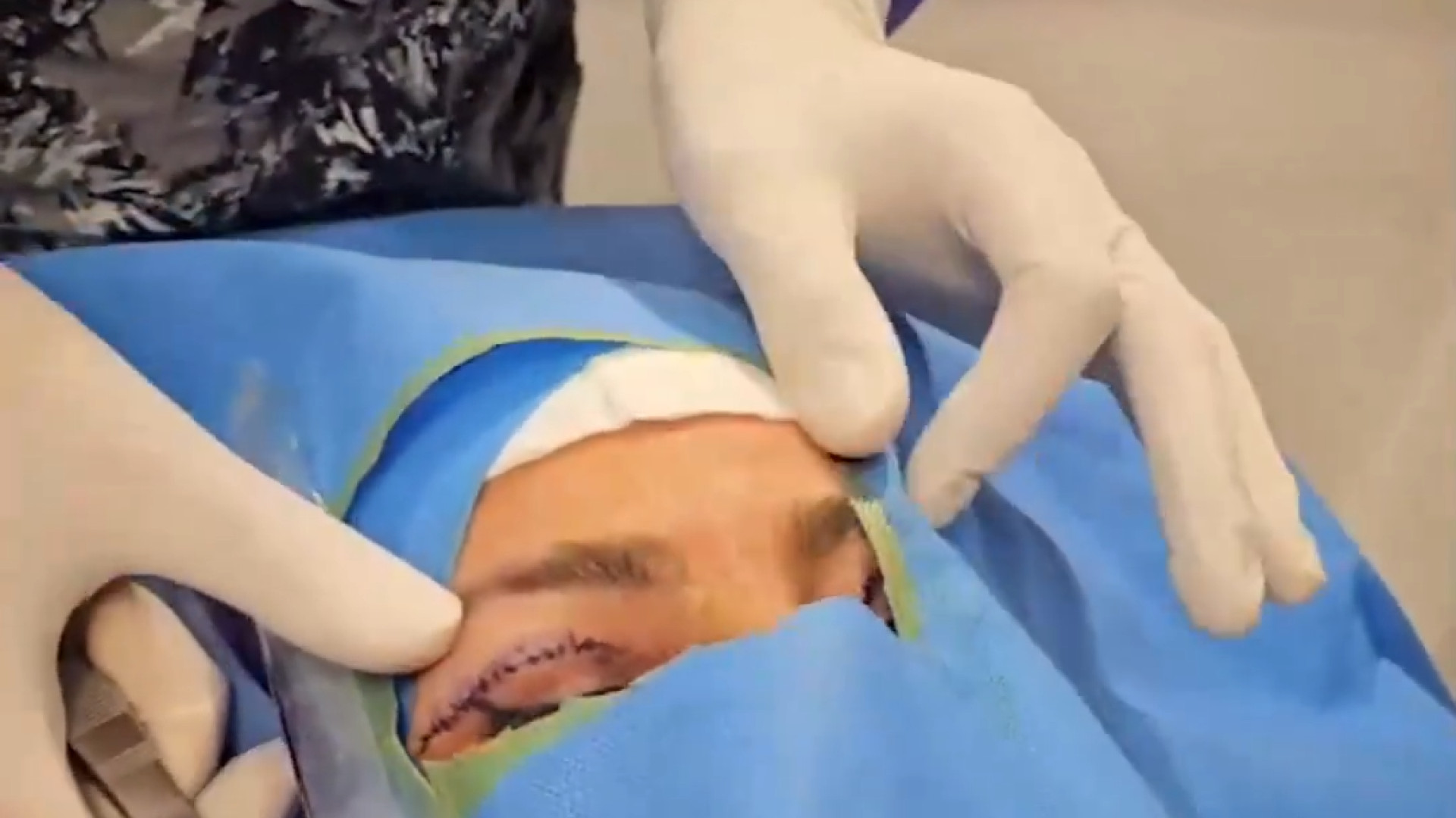 بلفاروپلاستی Blepharoplasty یا جراحی پلک | دکتر علی واجاری دکتر علی حسینی واجاری - جراح بینی رشت
