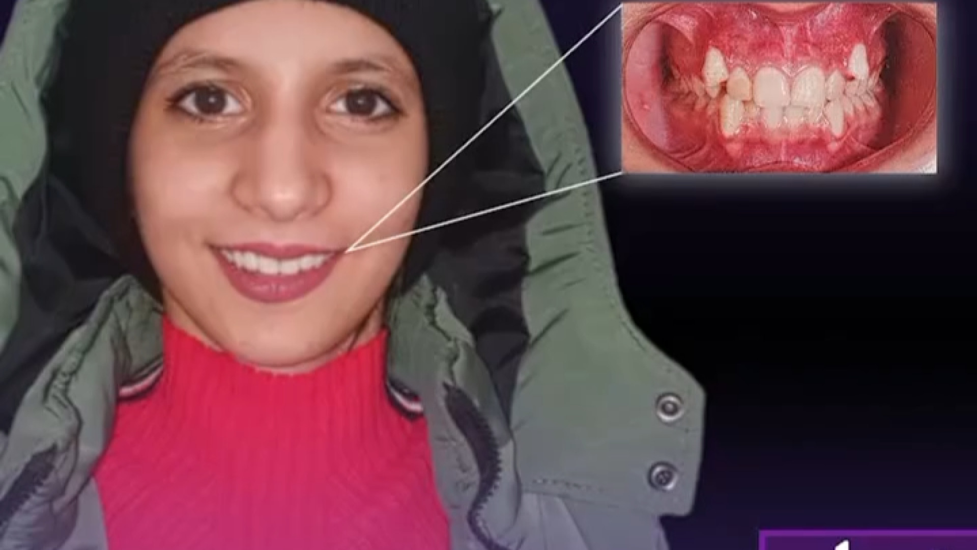 نتیجه درمان ارتودنسی ثابت با دکتر یوسف نژاد دکتر ثریا یوسف نژاد متخصص ارتودنسی بابل