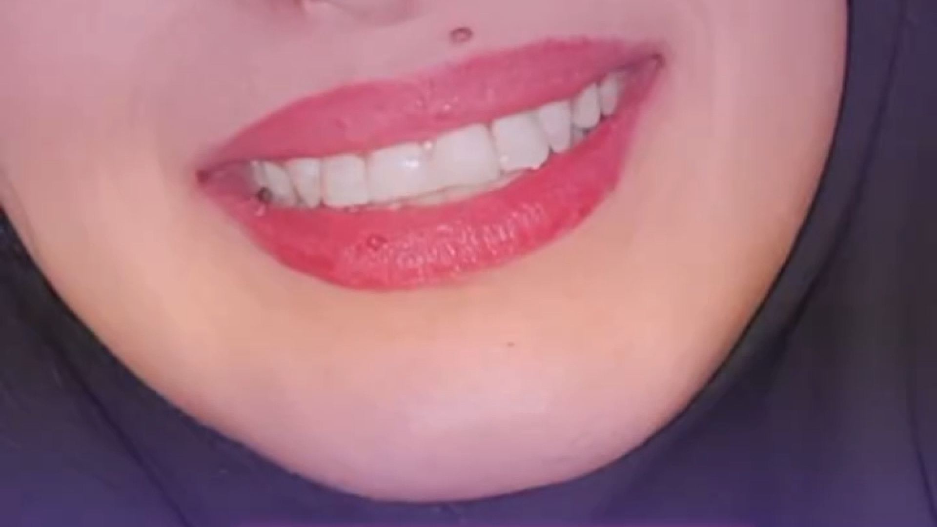 درمان ارتودنسی ثابت نتیجه ای زیبا و دیدنی دکتر ثریا یوسف نژاد متخصص ارتودنسی بابل