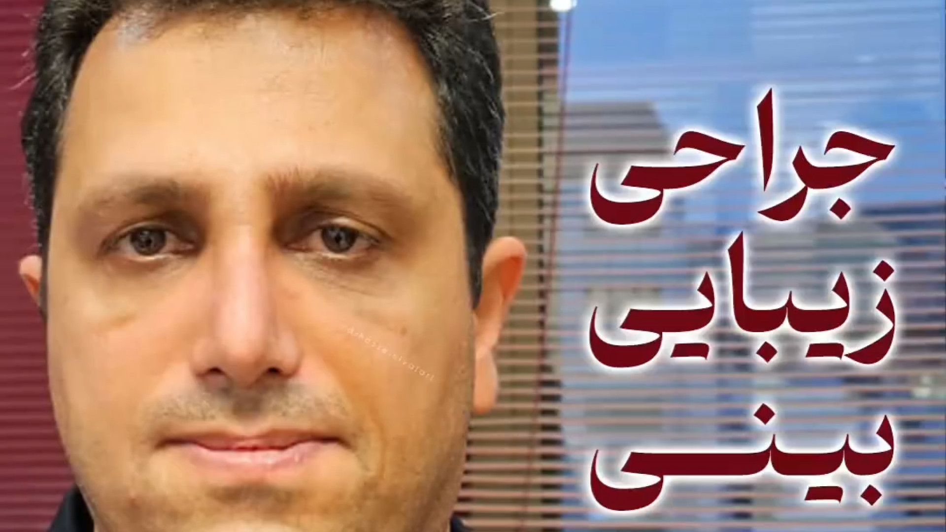 نتیجه جراحی بینی شکسته | دکتر علی واجاری دکتر علی حسینی واجاری - جراح بینی رشت