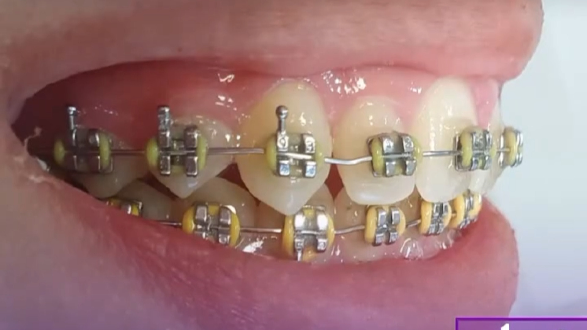 درمان ارتودنسی دندان ثابت گونه است؟ دکتر ثریا یوسف نژاد متخصص ارتودنسی بابل