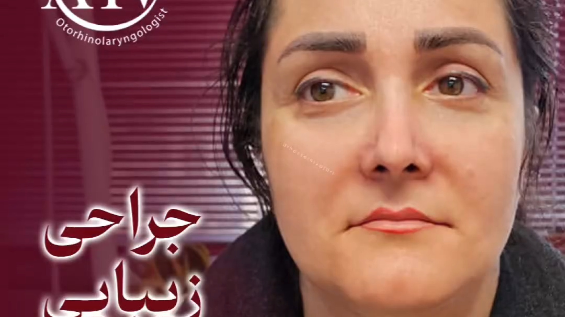 رینوپلاستی به صورت نچرال | دکتر علی واجاری دکتر علی حسینی واجاری - جراح بینی رشت