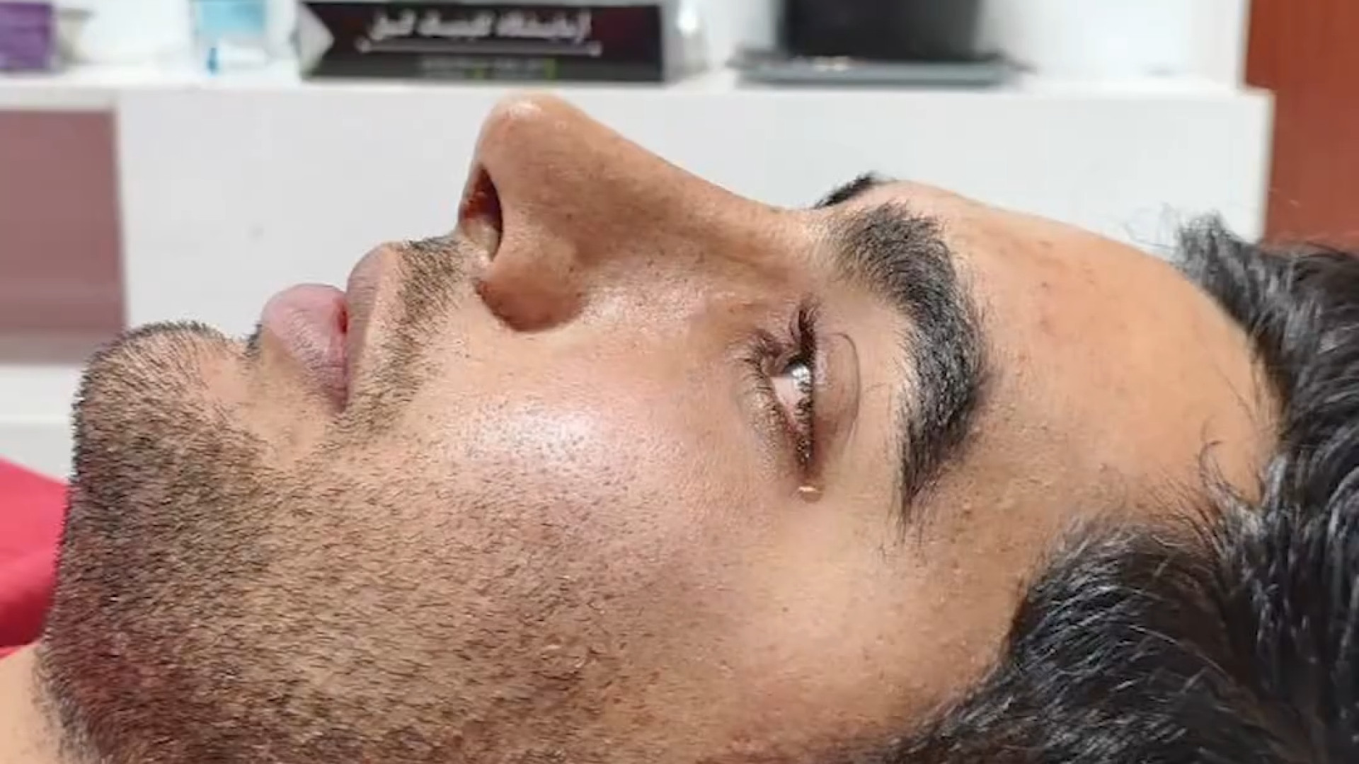 قبل و بعد از عمل بینی مردانه | دکتر علی واجاری دکتر علی حسینی واجاری - جراح بینی رشت