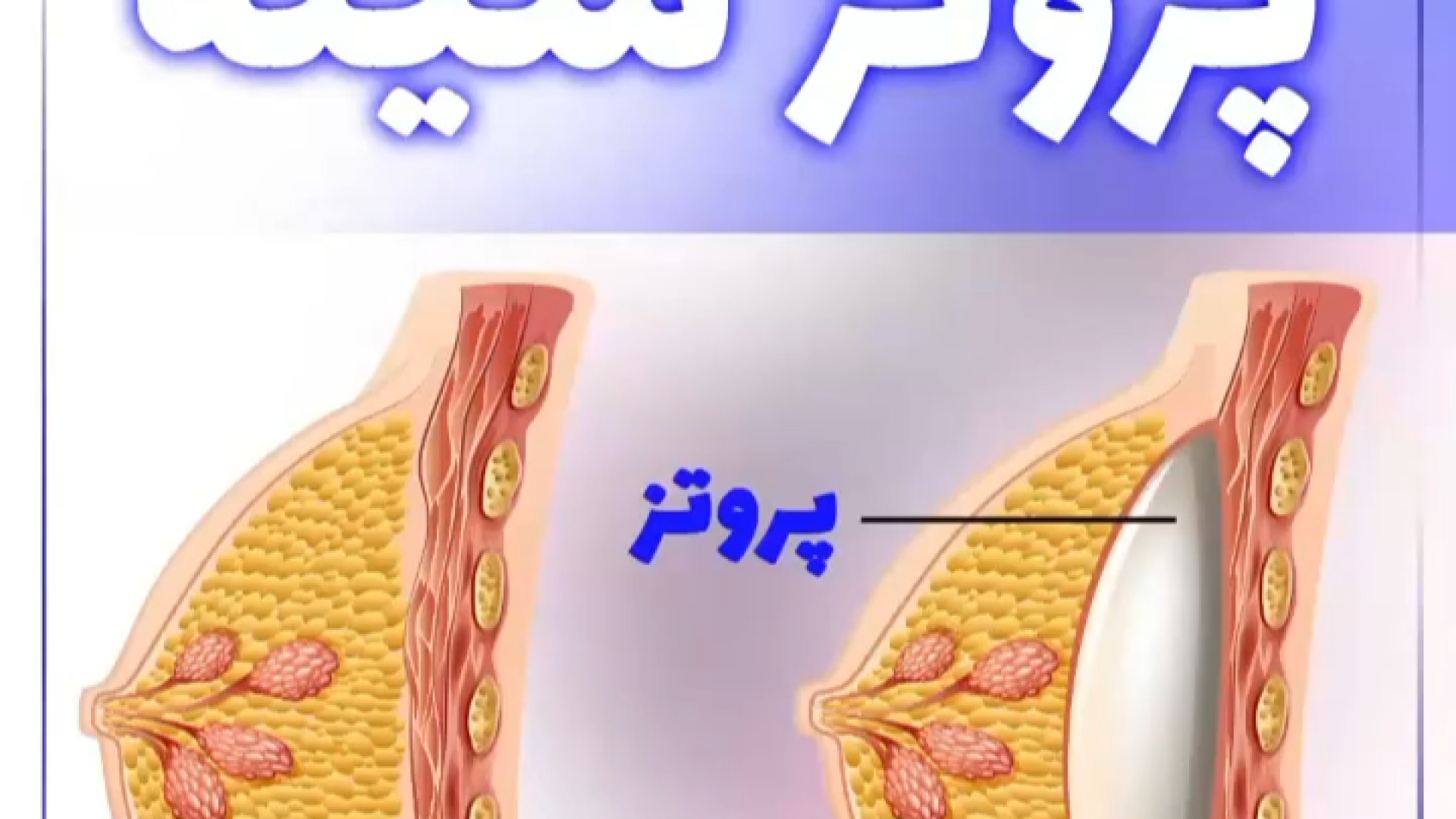 بزرگ کردن سینه با کاشت پروتز سینه ترمیم ونیر