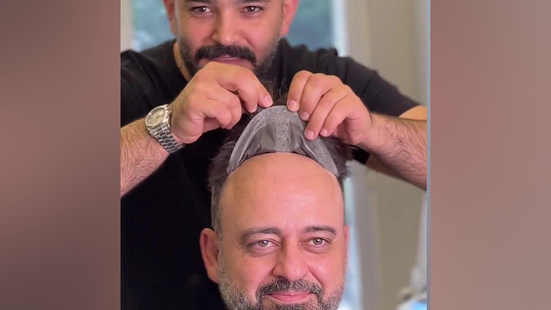 کاشت مو چسبی هموکروماتوز