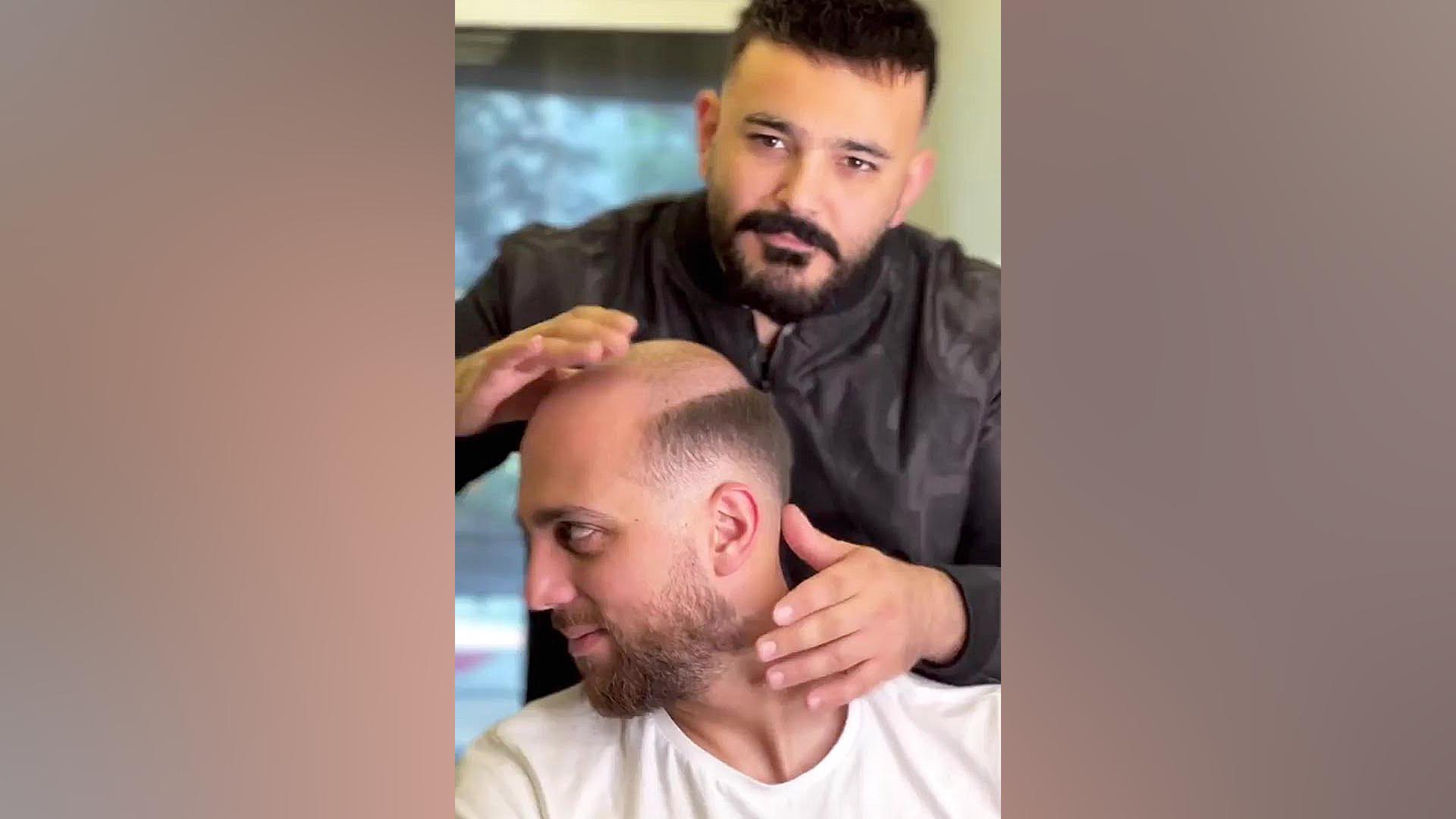 کاشت مو ضرر دارد لیزر صورت