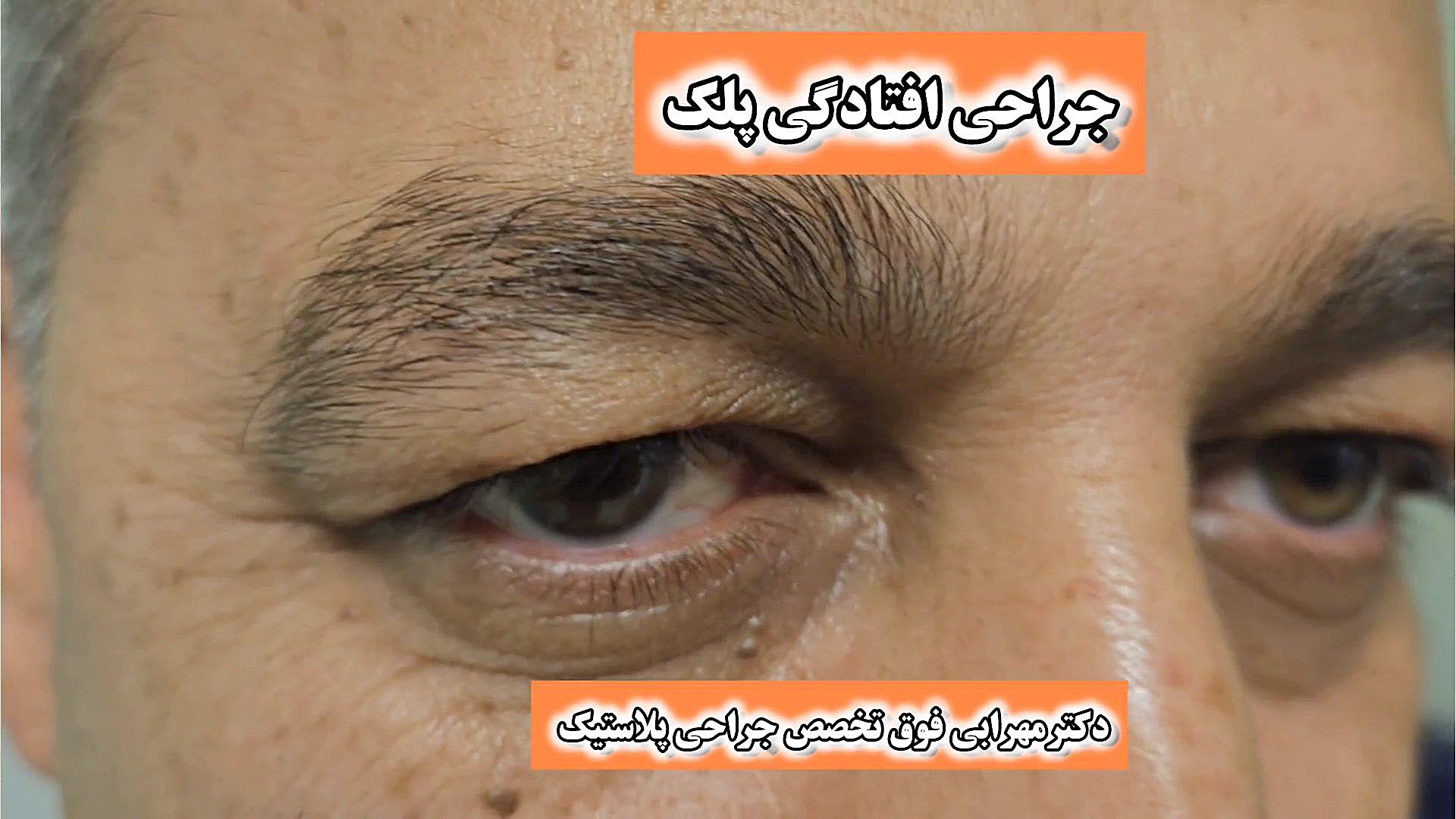 عمل افتادگی پلک بلفاروپلاستی پوست اضافی پلک در شیراز دکترمهرابی دکتر محمد مهدی مهرابی جراح پلاستیک و زیبایی
