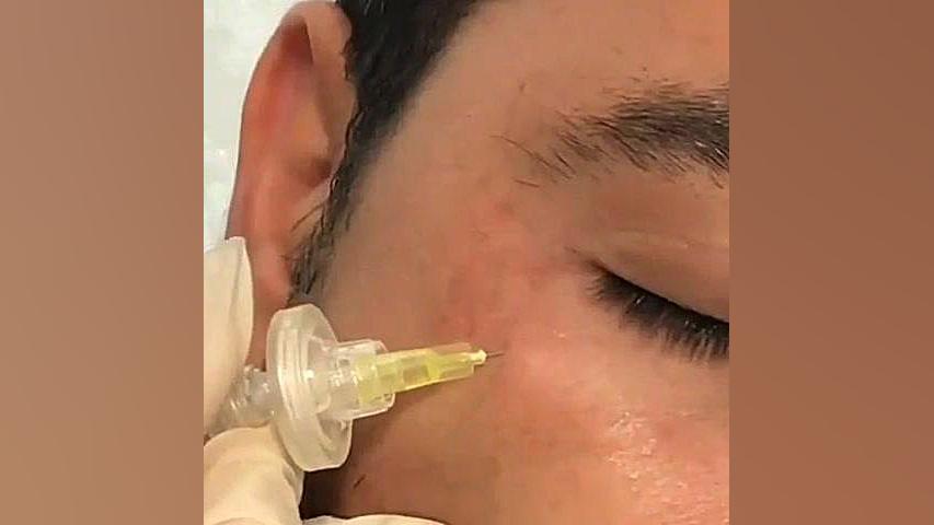 از بین بردن سیاهی دور چشم با دستگاه پزشکی Carboxy Therapy فیسبوک