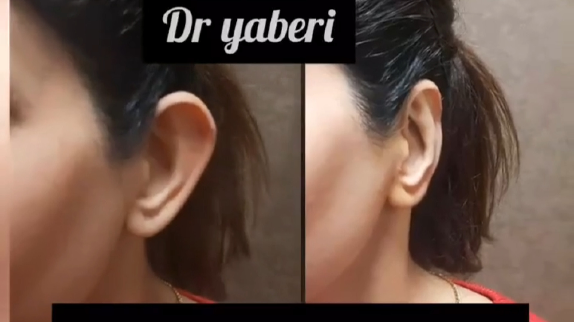 رفع برجستگی گوش با بیحسی | دکتر راضیه یابری گلوسودینیا