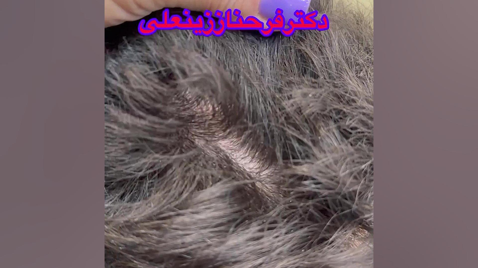 نتیجه عالی درمان ریزش موی هورمونی توسط دکتر فرحناز زینعلی دکتر فرحناز زینعلی - متخصص پوست، مو، زیبایی زنجان