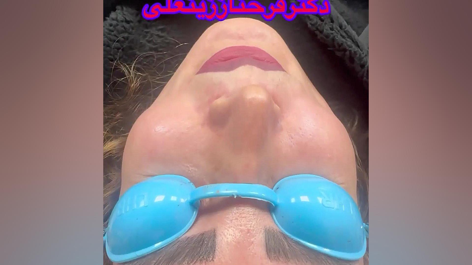 نتیجه تزریق چربی بعد از چهارسال دکتر فرحناز زینعلی - متخصص پوست، مو، زیبایی زنجان