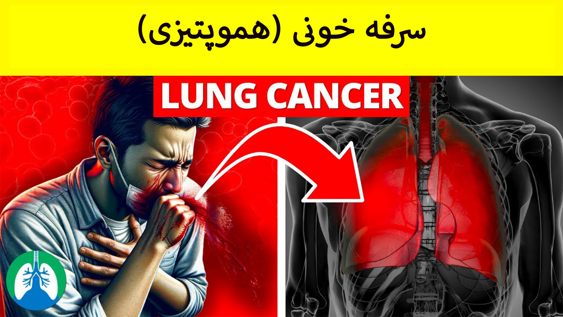 ارتباط سرفه خونی و سرطان ریه/ خلط خونی نشانه چیست و چه درمانی دارد؟ جراحی بینی
