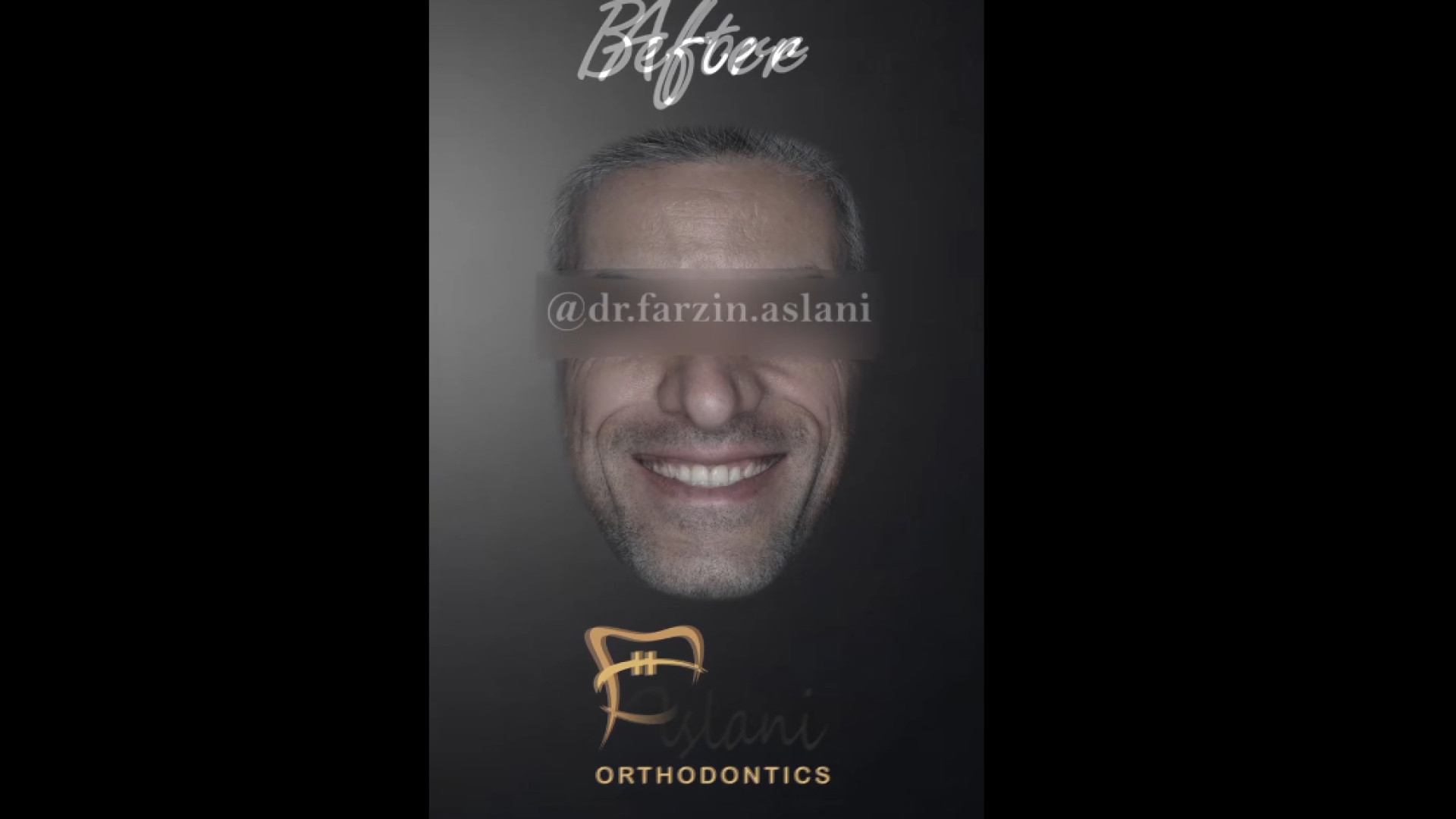 ارتودنسی و جراحی فک (ارتوسرجری) به منظور عقب بردن فک پایین GRO-Seq