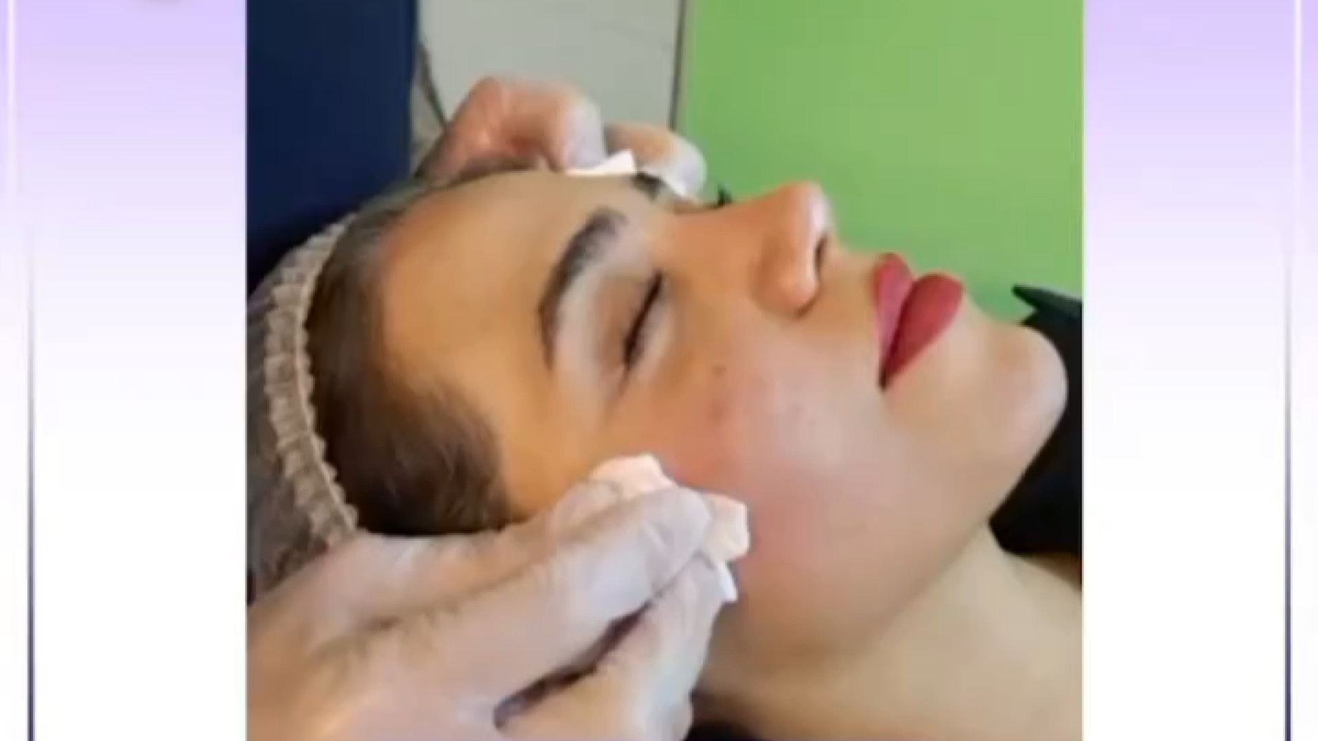 اسکار های اکنه | کلینیک سپاهان هشتگ خرسی