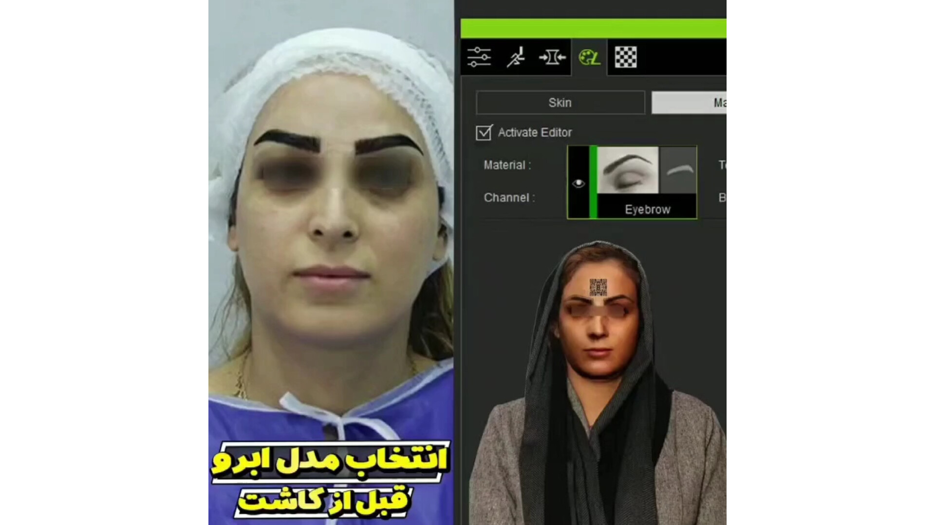 انتخاب مدل ابرو قبل از کاشت ابرو با هوش مصنوعی جراحی بینی