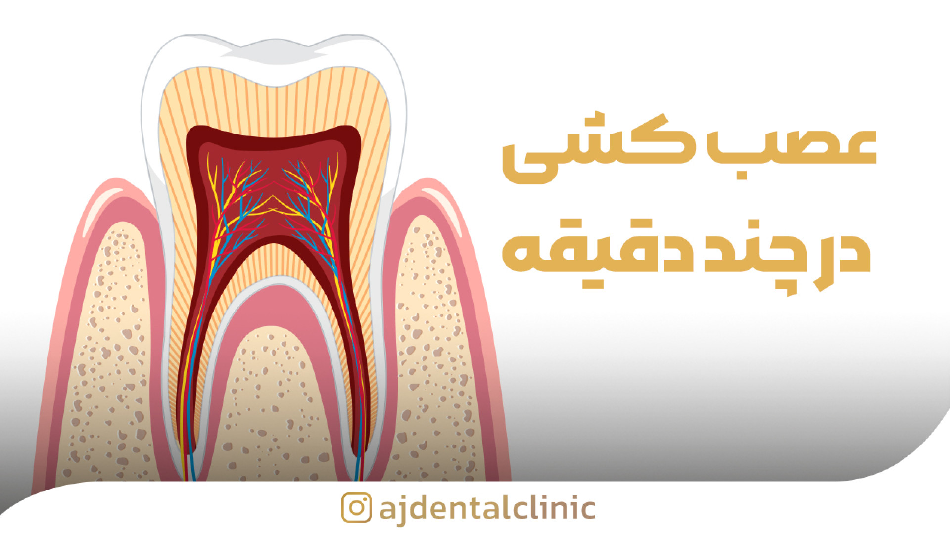 عصب کشی در چند دقیقه | کلینیک دندانپزشکی عاج اینسایزینگ
