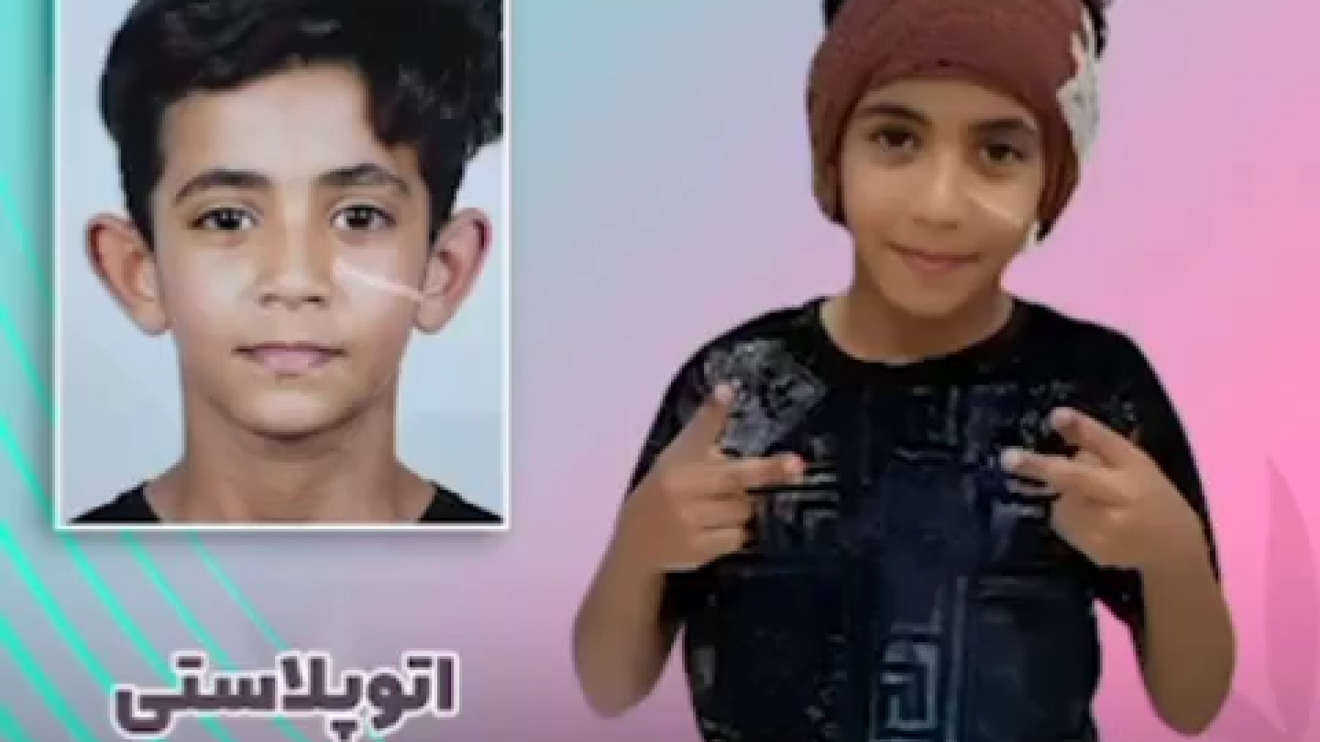 جراحی گوش | دکتر مینو مددی نیا لیپوساکشن