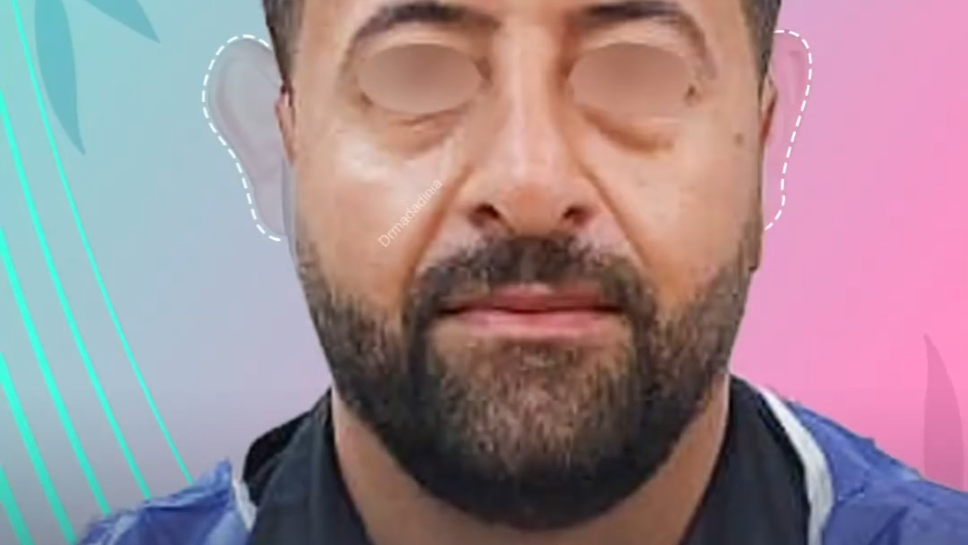 اصلاح گوش برجسته | دکتر مینو مددی نیا CUT&Tag