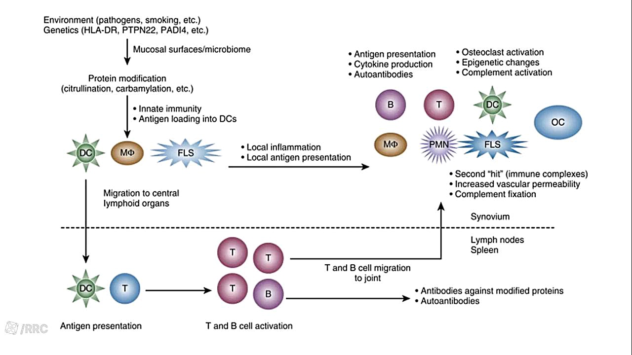 Ethiology and Pathogenesis of Rheumatoid Arthritis پالپوتومی