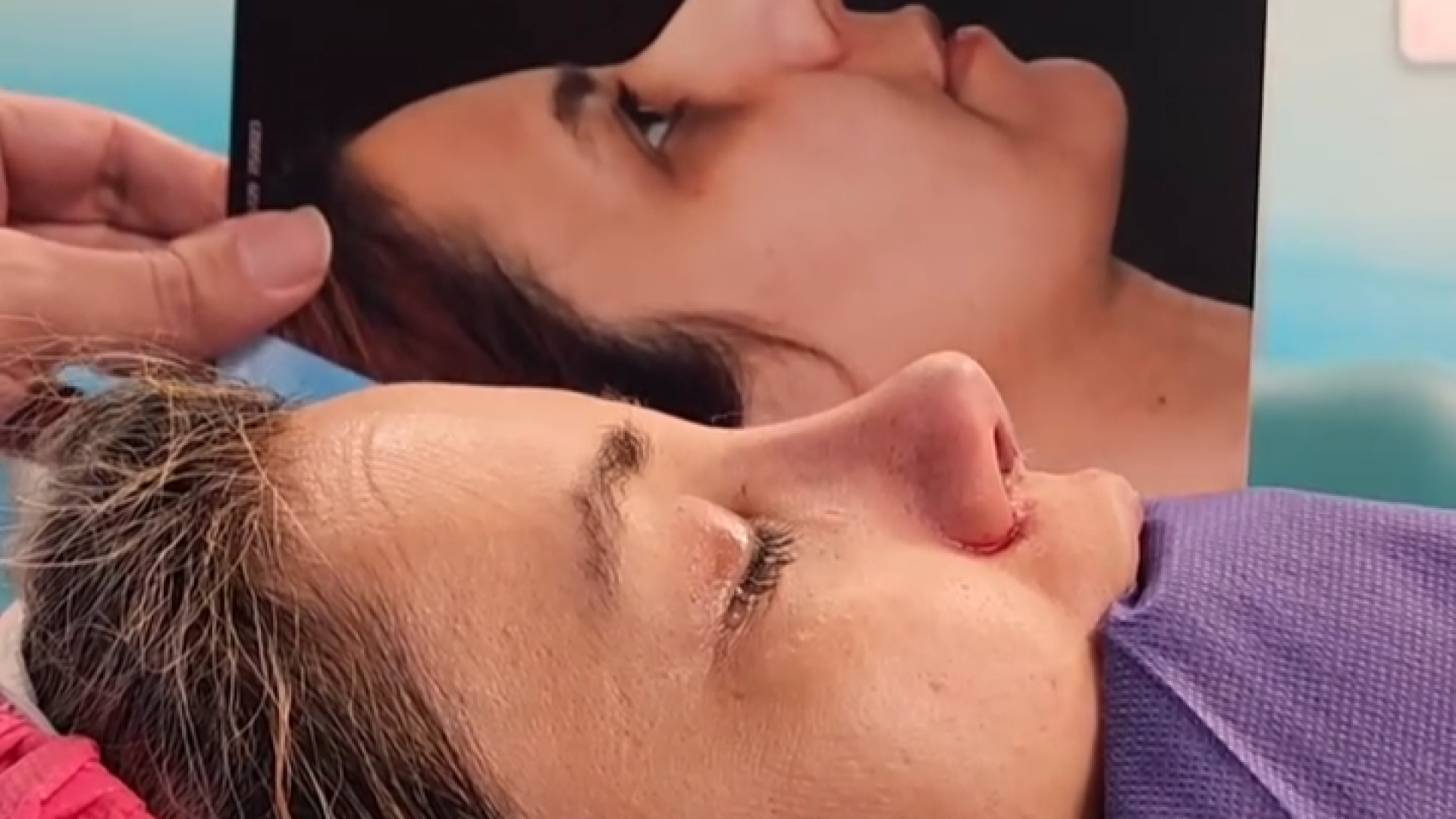 بلافاصله بعد از رینوپلاستی | دکتر امین قانعی دکتر امین قانعی - جراح پلاستیک در اصفهان