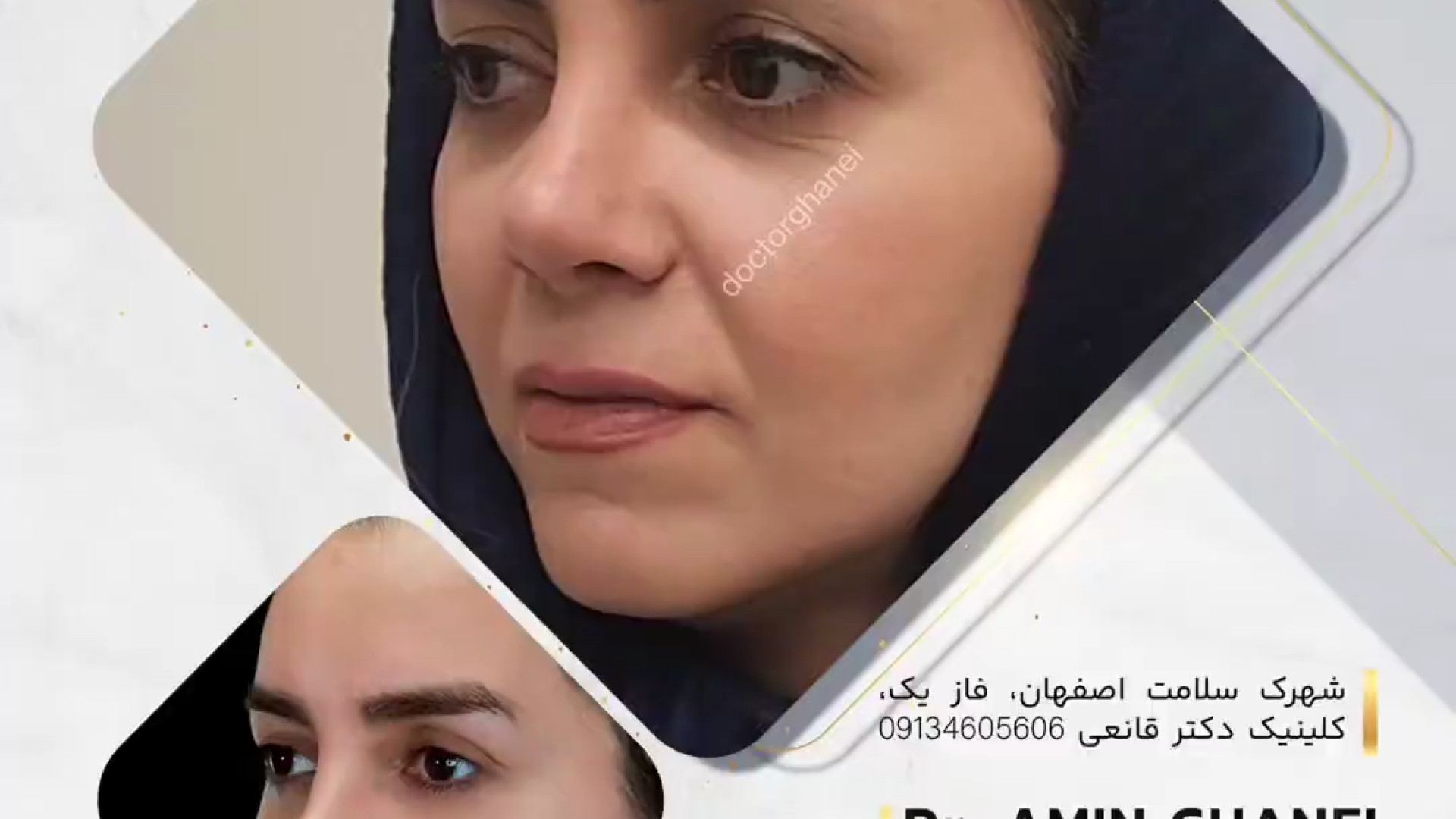 هفت ماه پس از عمل ترمیمی بینی | دکتر امین قانعی دکتر امین قانعی - جراح پلاستیک در اصفهان