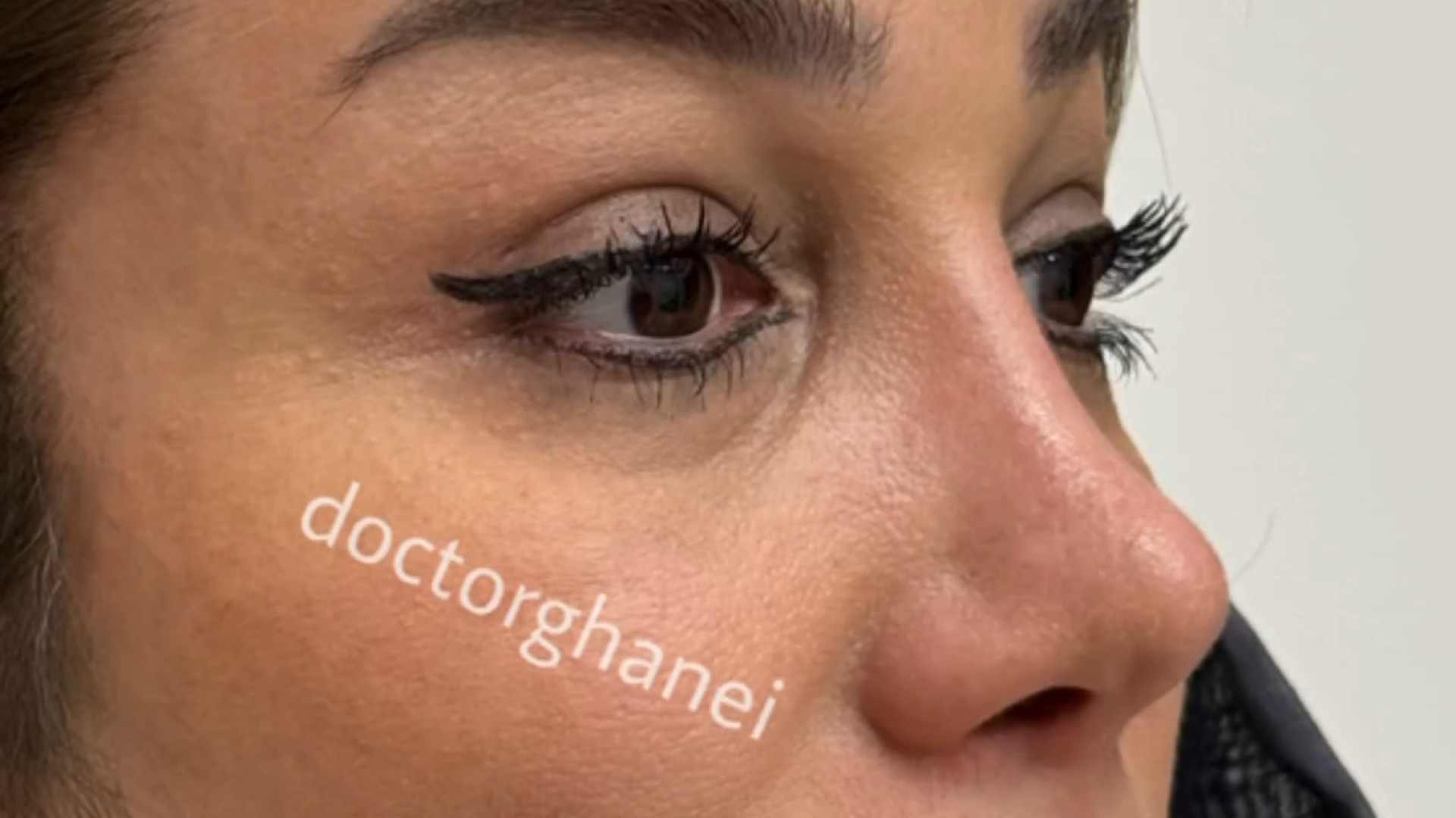 جراحی همزمان بینی ترمیمی و لیفت پیشانی و شقیقه | دکتر امین قانعی دکتر امین قانعی - جراح پلاستیک در اصفهان