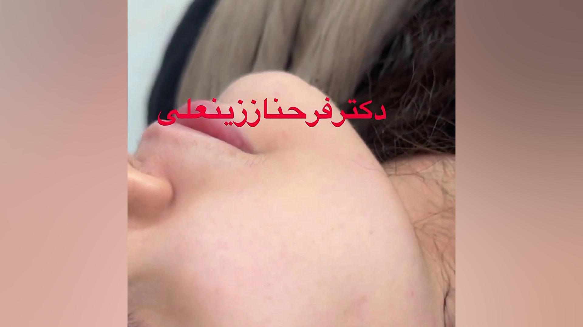 درمان اسکار آکنه با سابسیژن و ادامه درمان با لیزر و اراف دکتر فرحناز زینعلی - متخصص پوست، مو، زیبایی زنجان