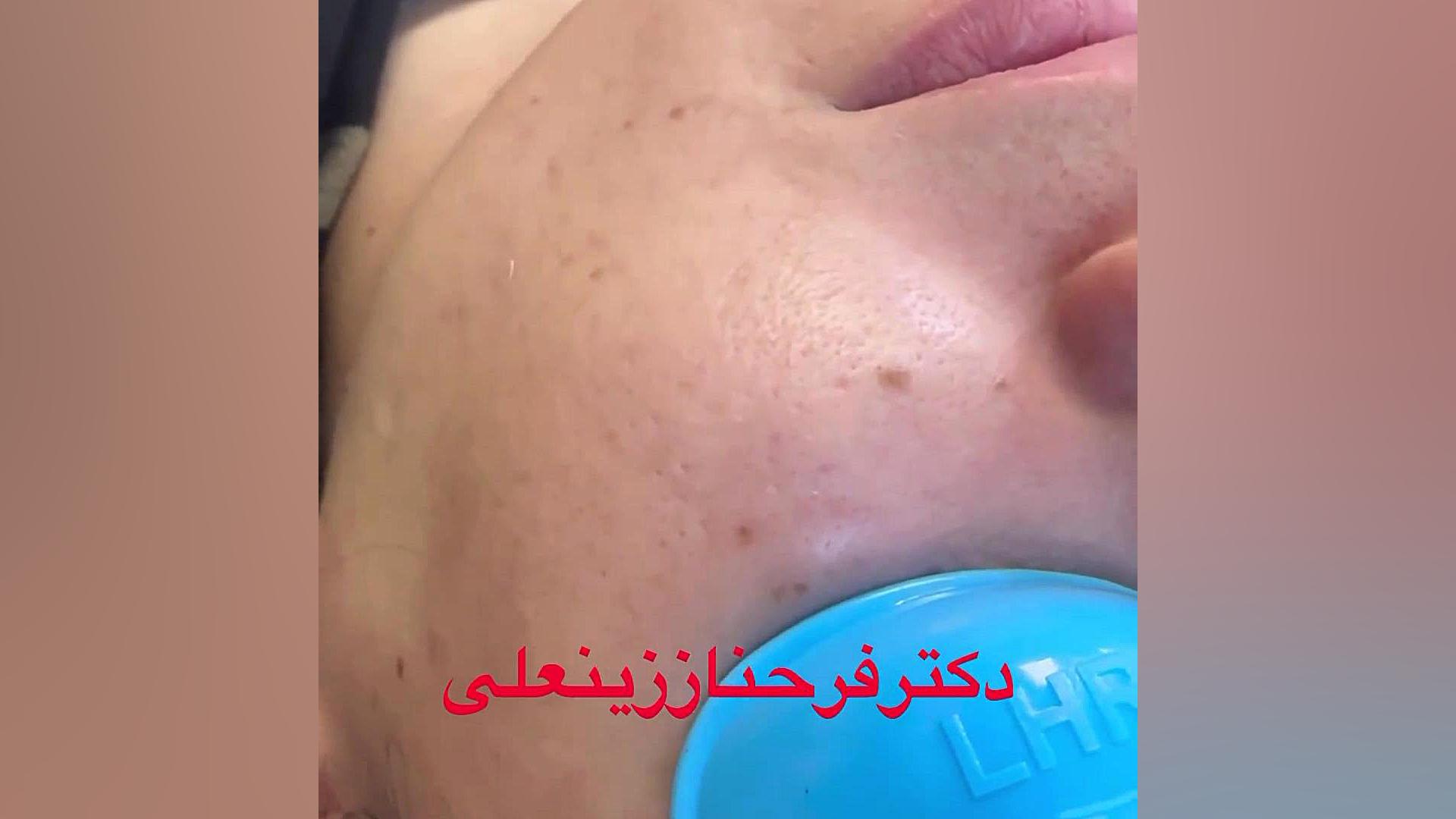برداشتن خال های صورت و پوست توسط پزشک متخصص دکتر فرحناز زینعلی - متخصص پوست، مو، زیبایی زنجان