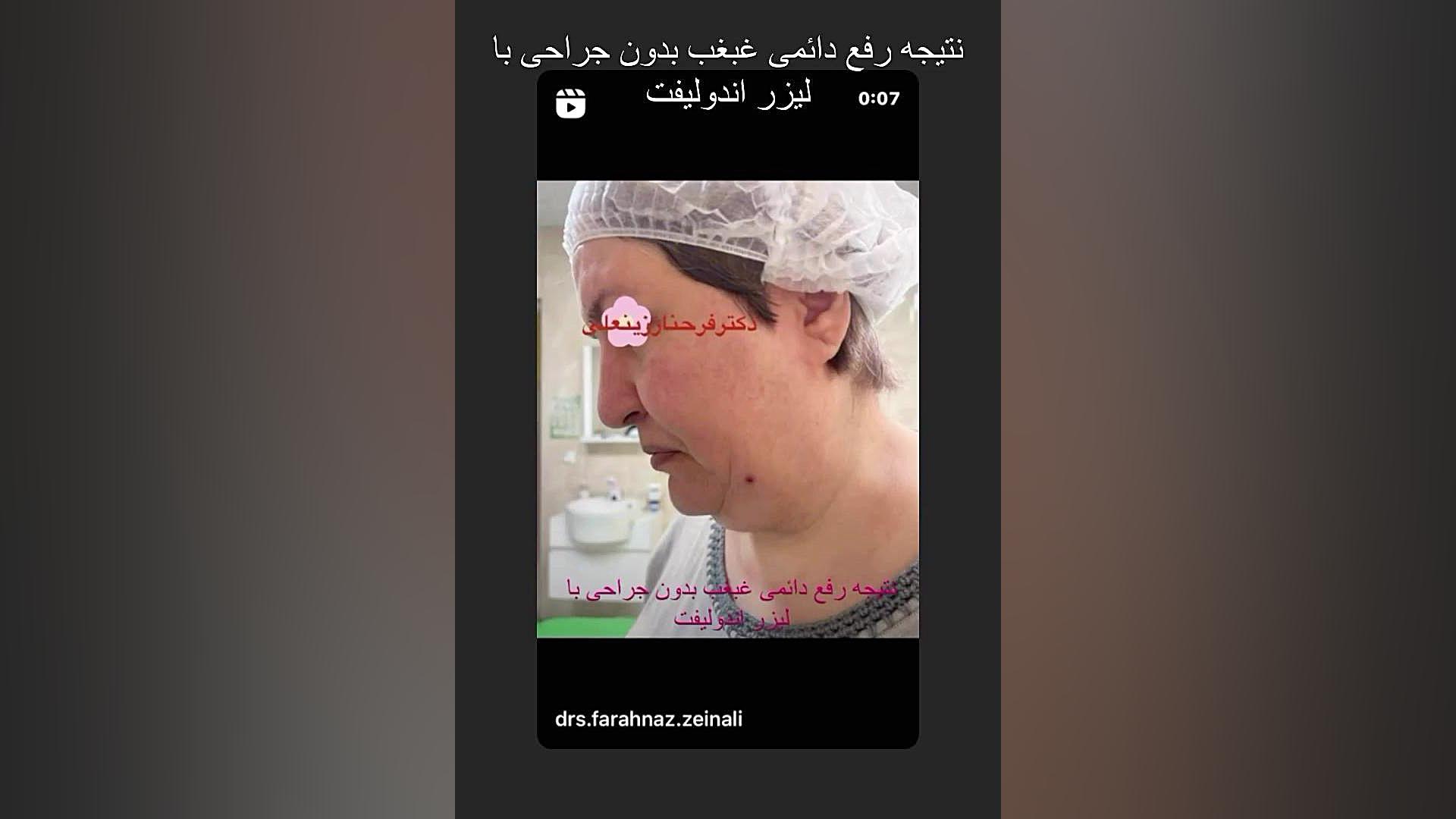 نتیجه رفع غبغب با لیزر اندولیفت دکتر فرحناز زینعلی - متخصص پوست، مو، زیبایی زنجان