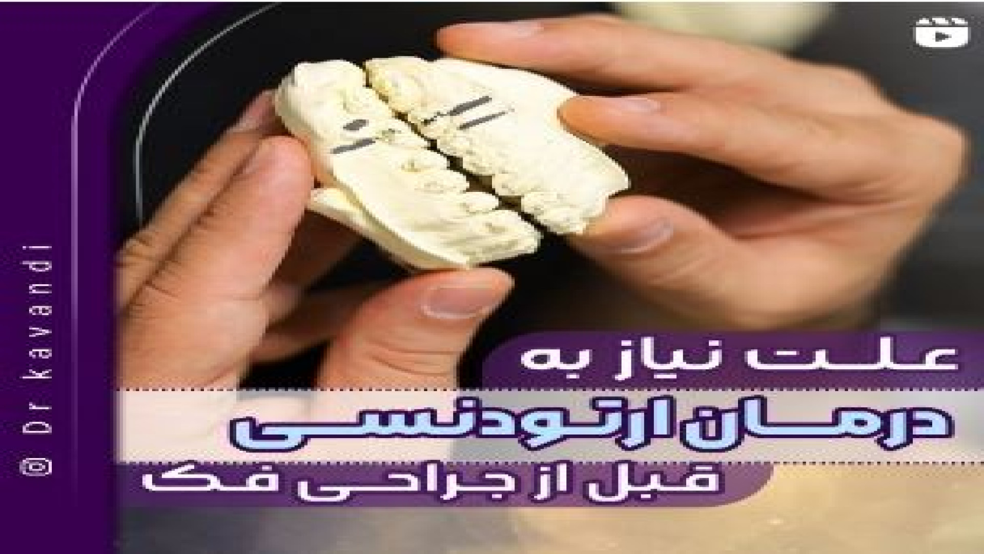 علت نیاز به درمان ارتودنسی قبل از جراحی فک آزمون آلدوستِرون پلاسما