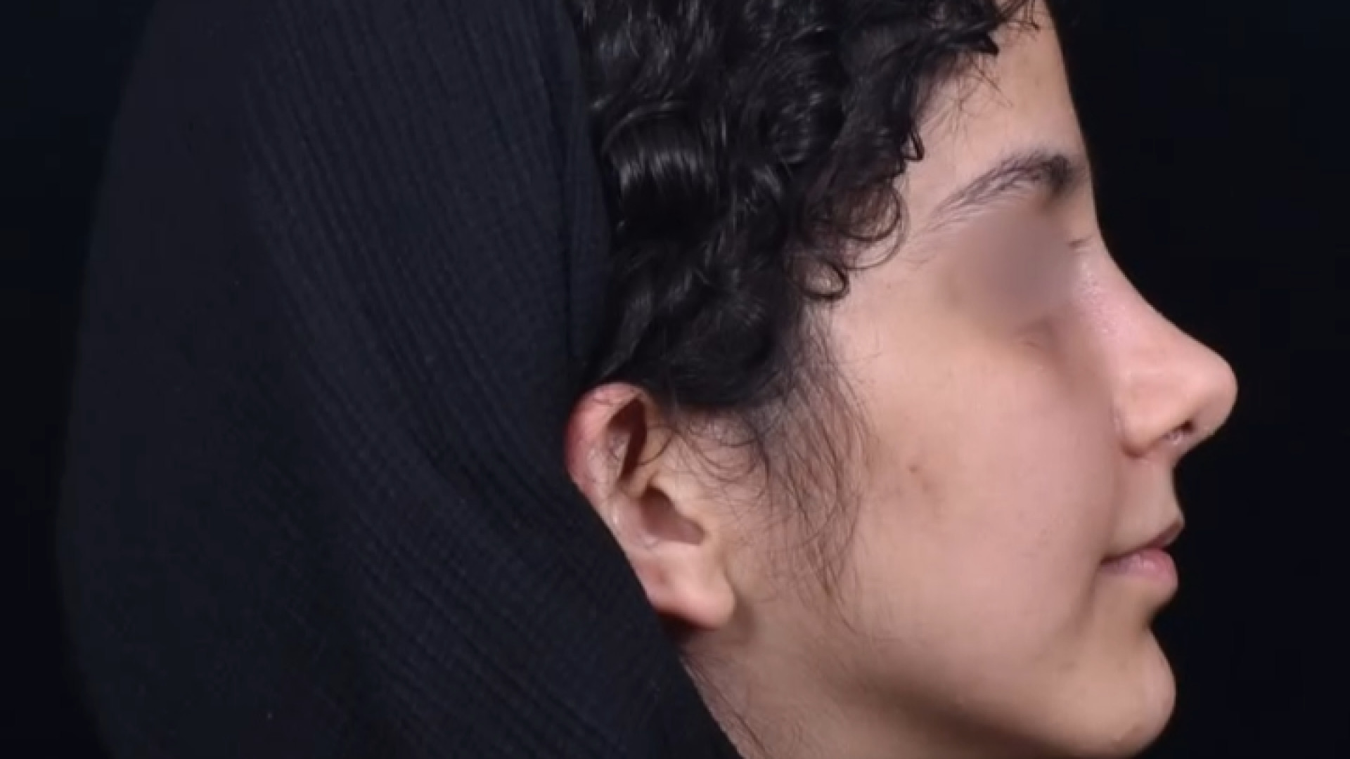 نتیجه ی فوق العاده جراحی رینوپلاستی دکتر حمید رضا فتحی فوق تخصص جراحی پلاستیک