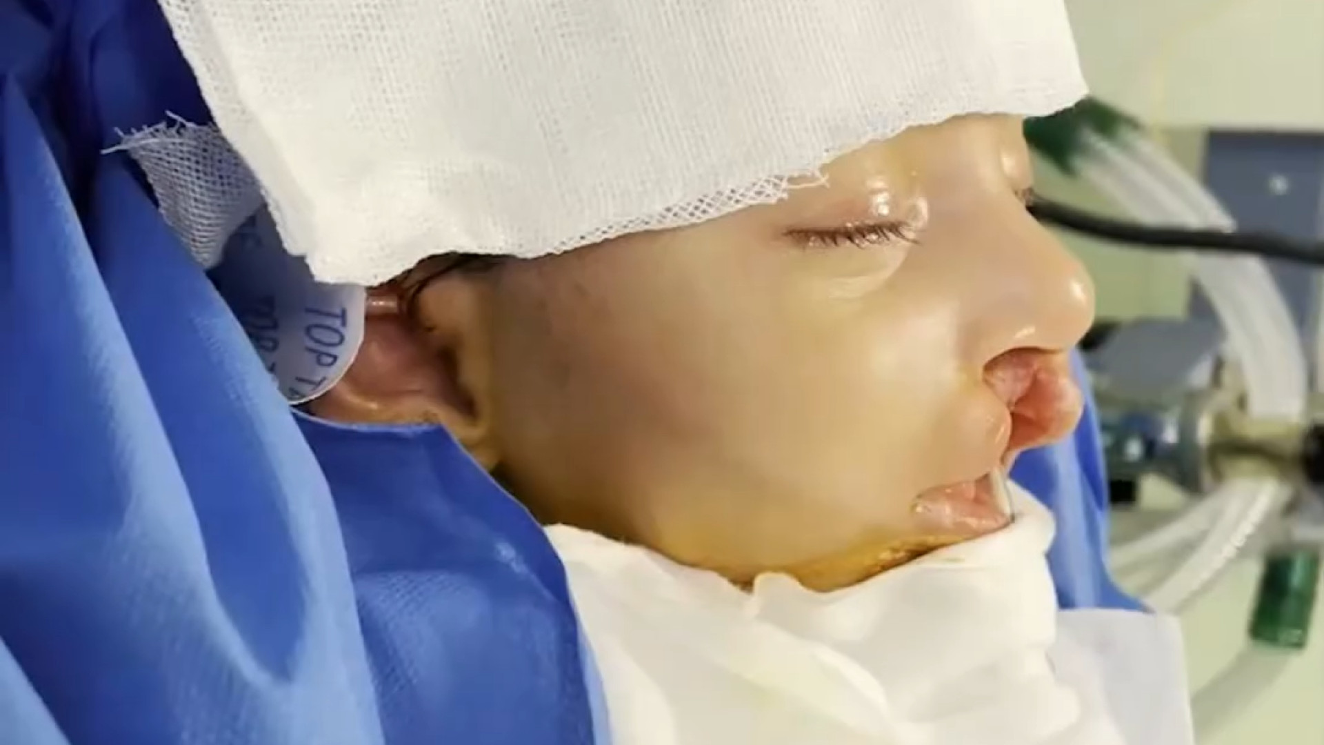 جراحی شکاف لب دکتر حمید رضا فتحی فوق تخصص جراحی پلاستیک
