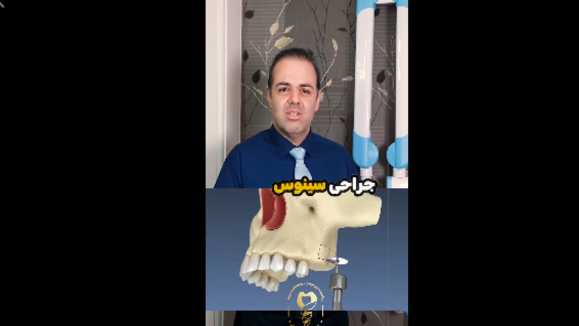 جراحی سینوس لیفت در زمان ایمپلنت دکتر علی قمری - متخصص جراحی لثه و ایمپلنت