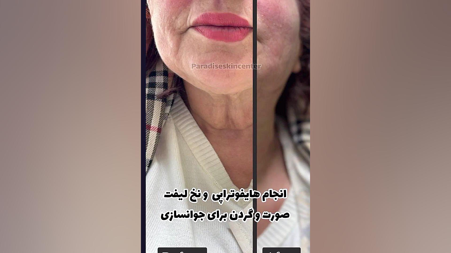 انجام هایفوتراپی و نخ لیفت صورت و گردن برای جوانسازی کشیدن دندان