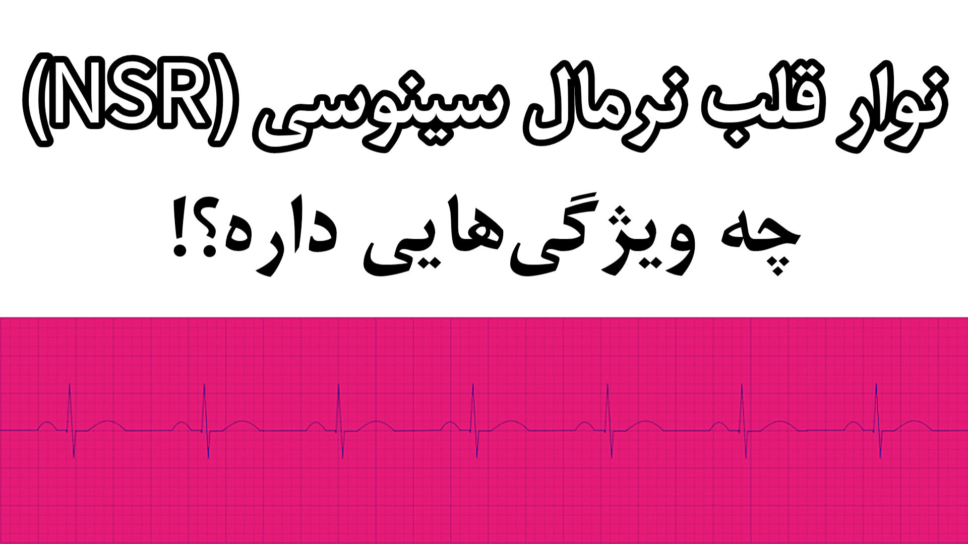 ریتم قلبی نرمال سینوسی نوار قلب NSR ECG RHYTHM پوسیدگی دندان