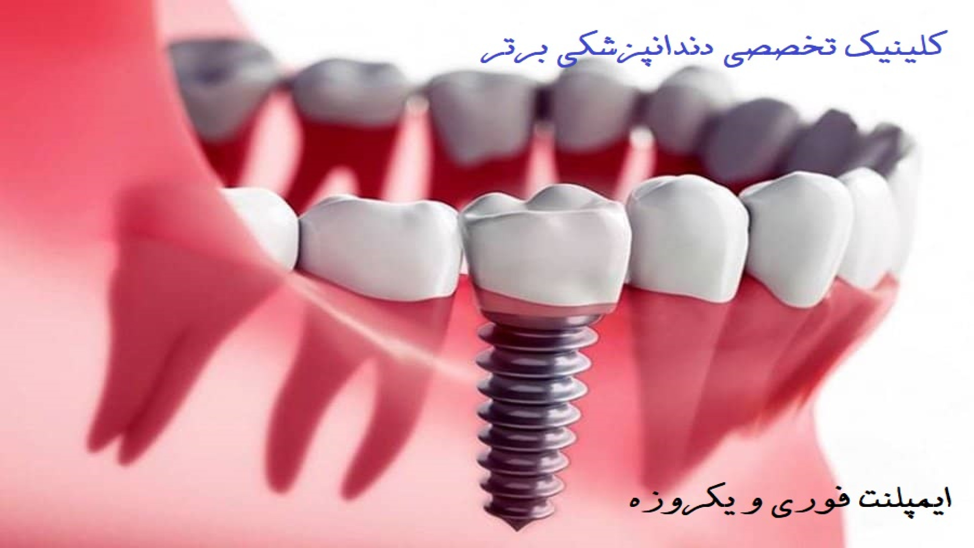 کاشت ایمپلنت فوری - ایمپلنت یک روزه دندان چیست و چگونه انجام می شود؟ پزشکی شخصی‌سازی‌شده سطح یاخته‌ای